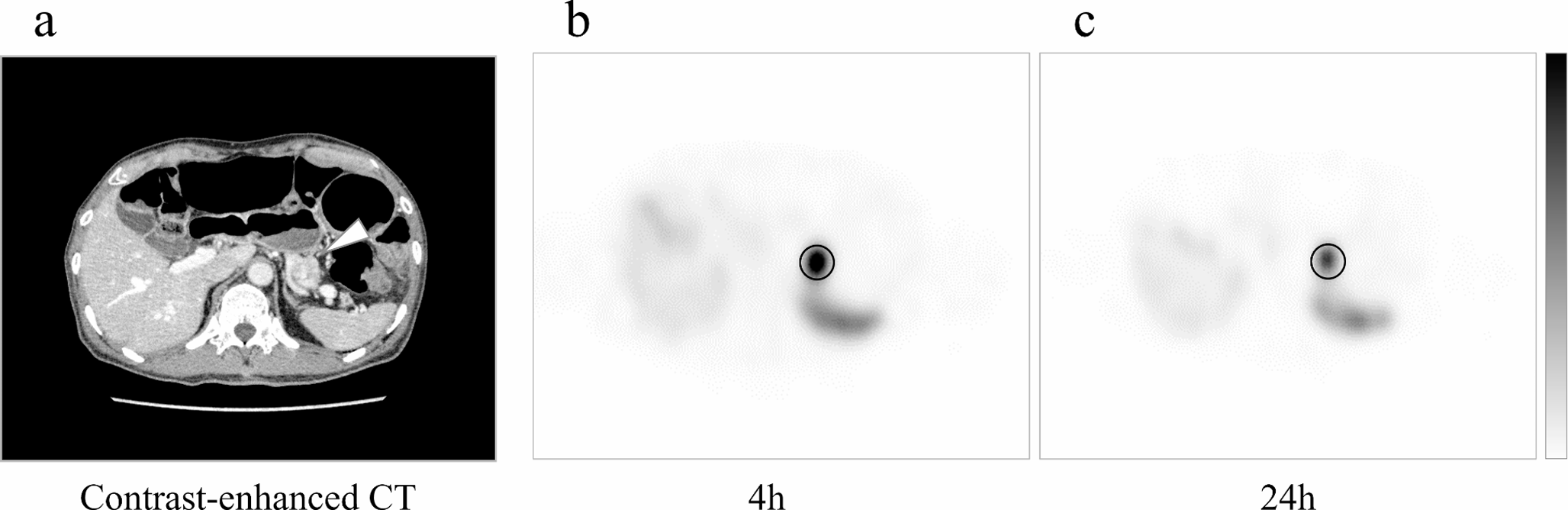 Quantification of In-Pentetreotide Single Photon Emission Computed Tomography Images in Gastrointestinal Neuroendocrine Tumors and Possibility of Grade Prediction