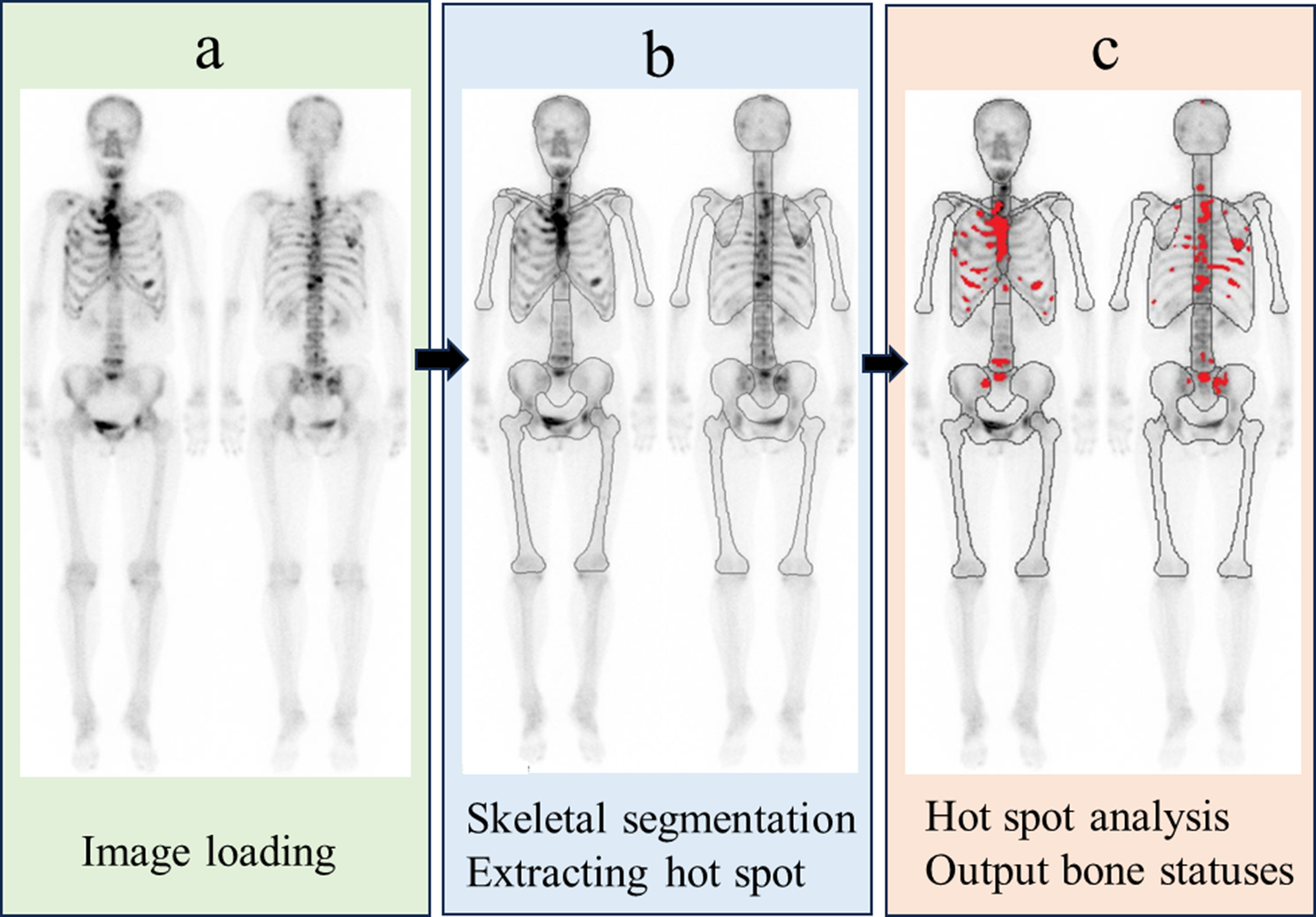 Accuracy of an Automated Bone Scan Index Measurement System Enhanced by Deep Learning of the Female Skeletal Structure in Patients with Breast Cancer