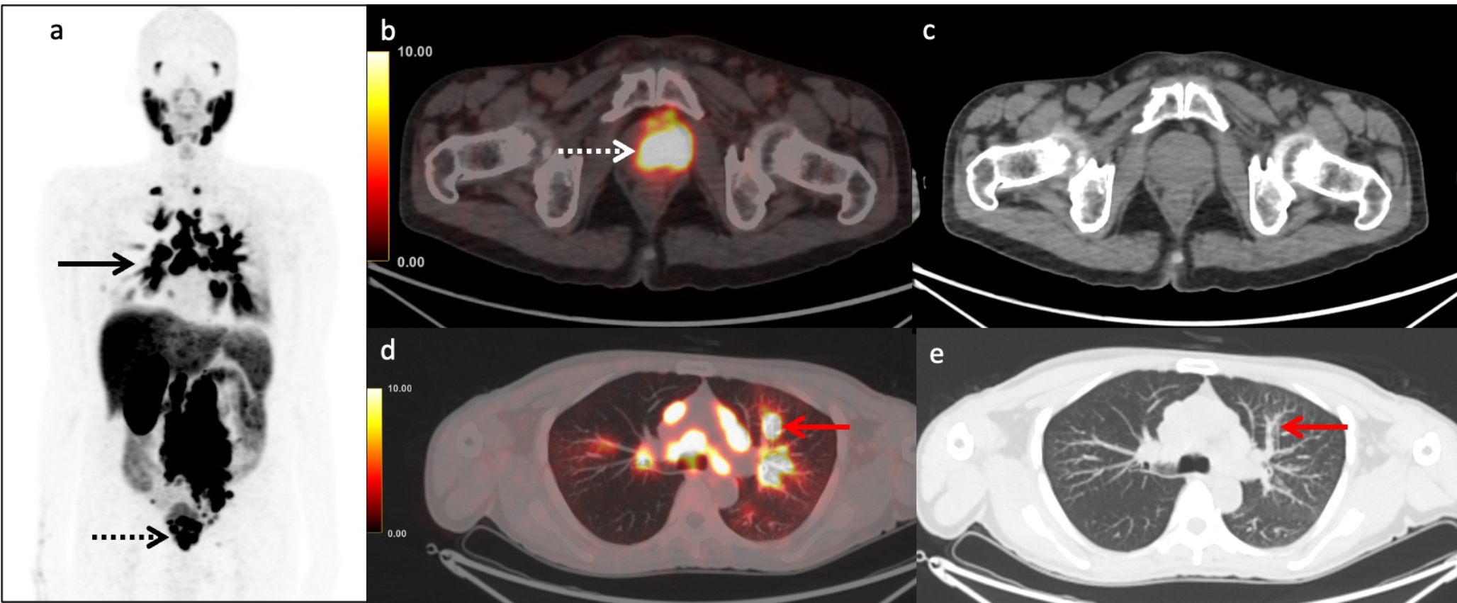 Incidental Detection of Pulmonary Lymphangitic Carcinomatosis on F-PSMA 1007 in a Case of Prostate Cancer Without Pulmonary Symptoms