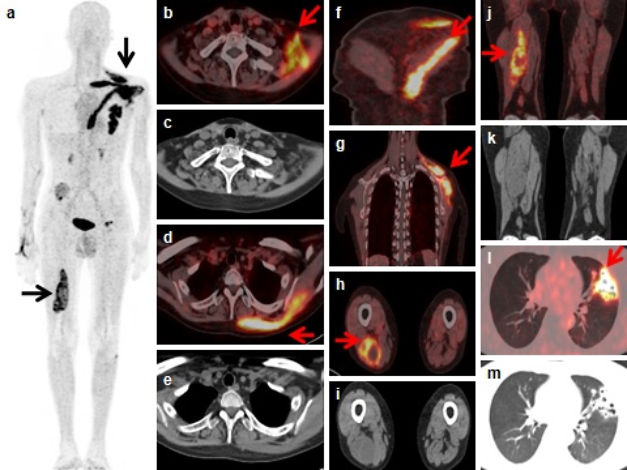 Ga FAPI PET in a Renal Transplant Patient with Disseminated Nocardiosis–A Worthwhile Imaging Modality for Infection Imaging