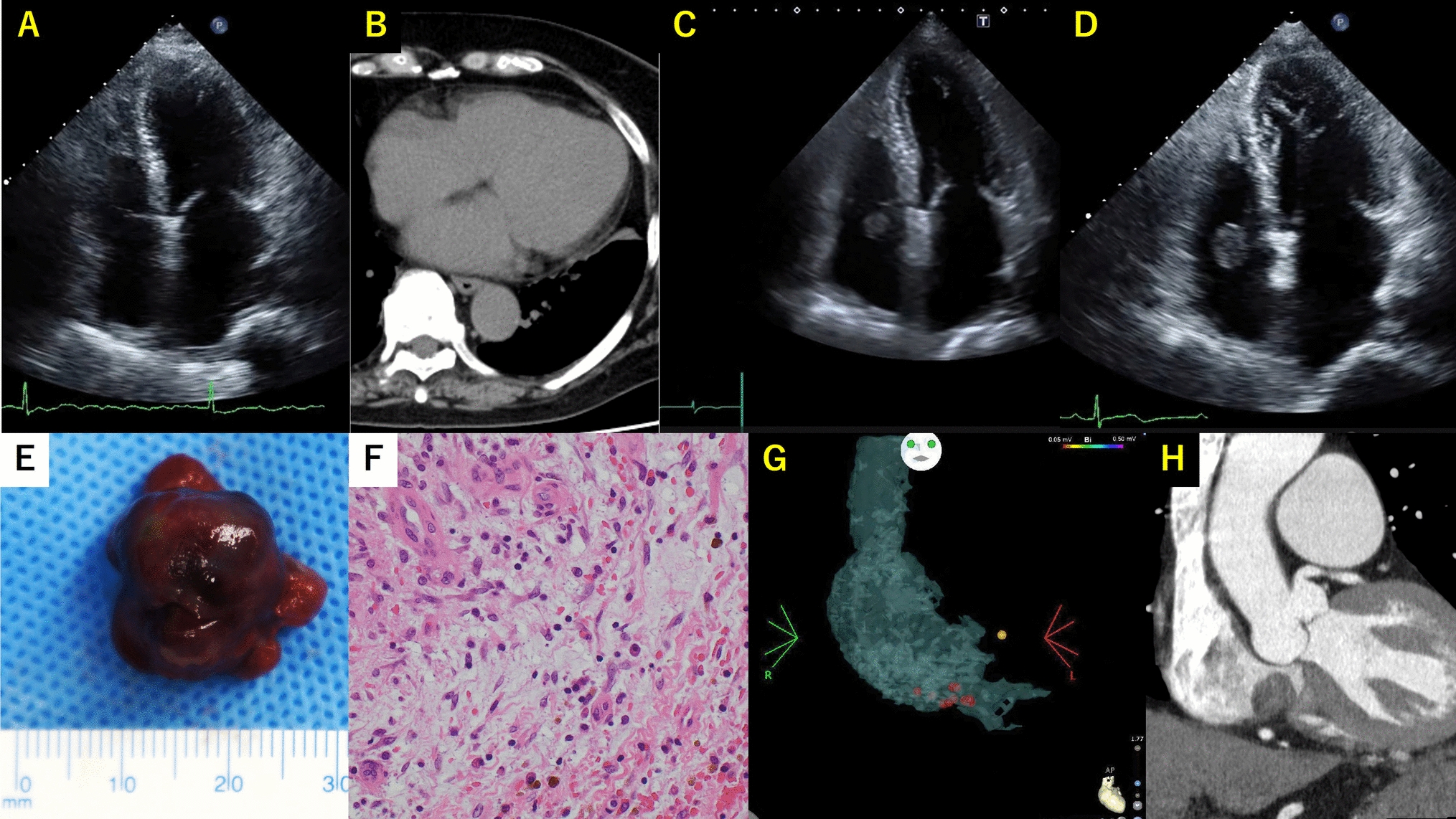 Right atrial myxoma after catheter ablation