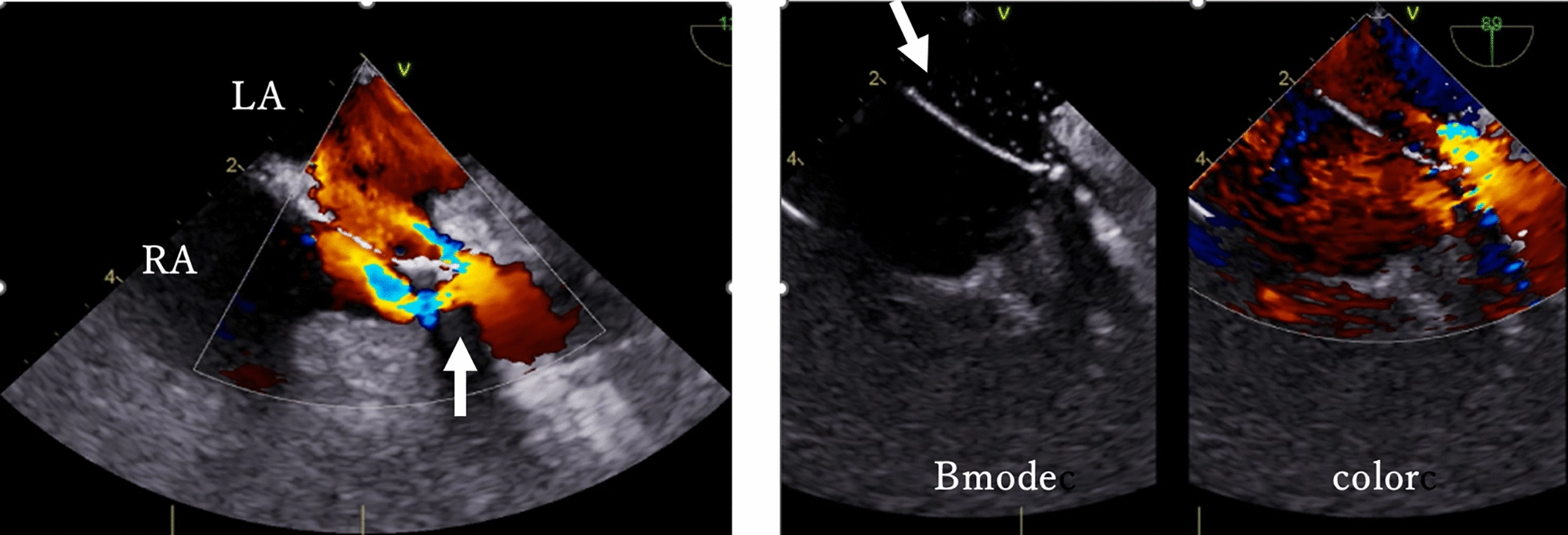 Contrast echocardiography proved useful in detecting abnormal flow following ASD closure during minimally invasive cardiac surgery: a case report