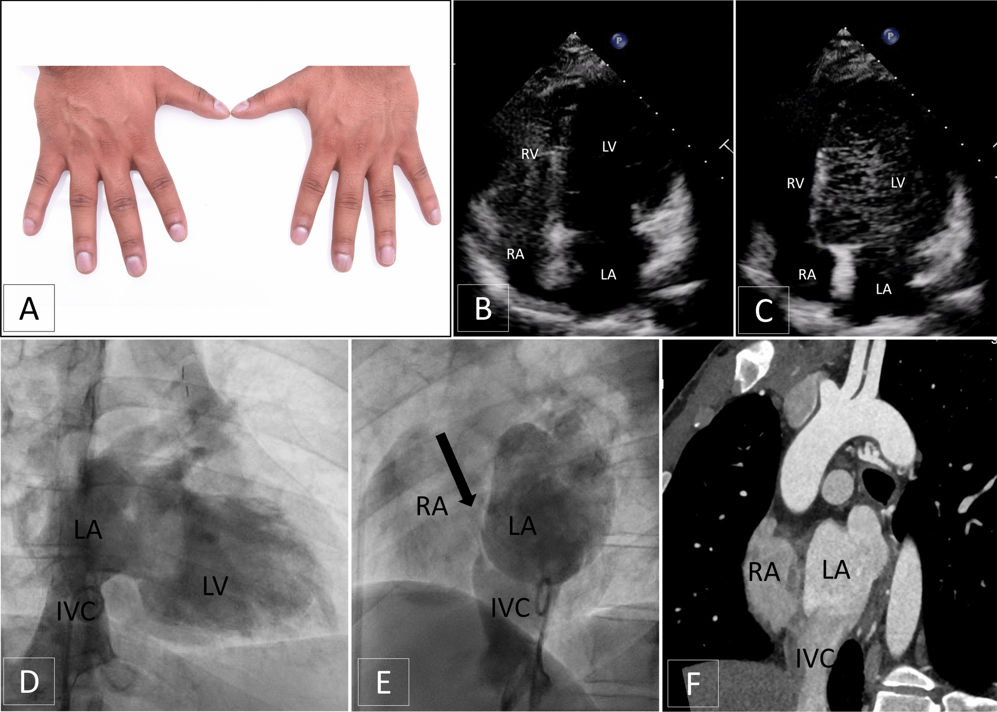 The enigma of late-onset cyanosis: uncovering an unexpected twist after ASD closure with bubble contrast echocardiography