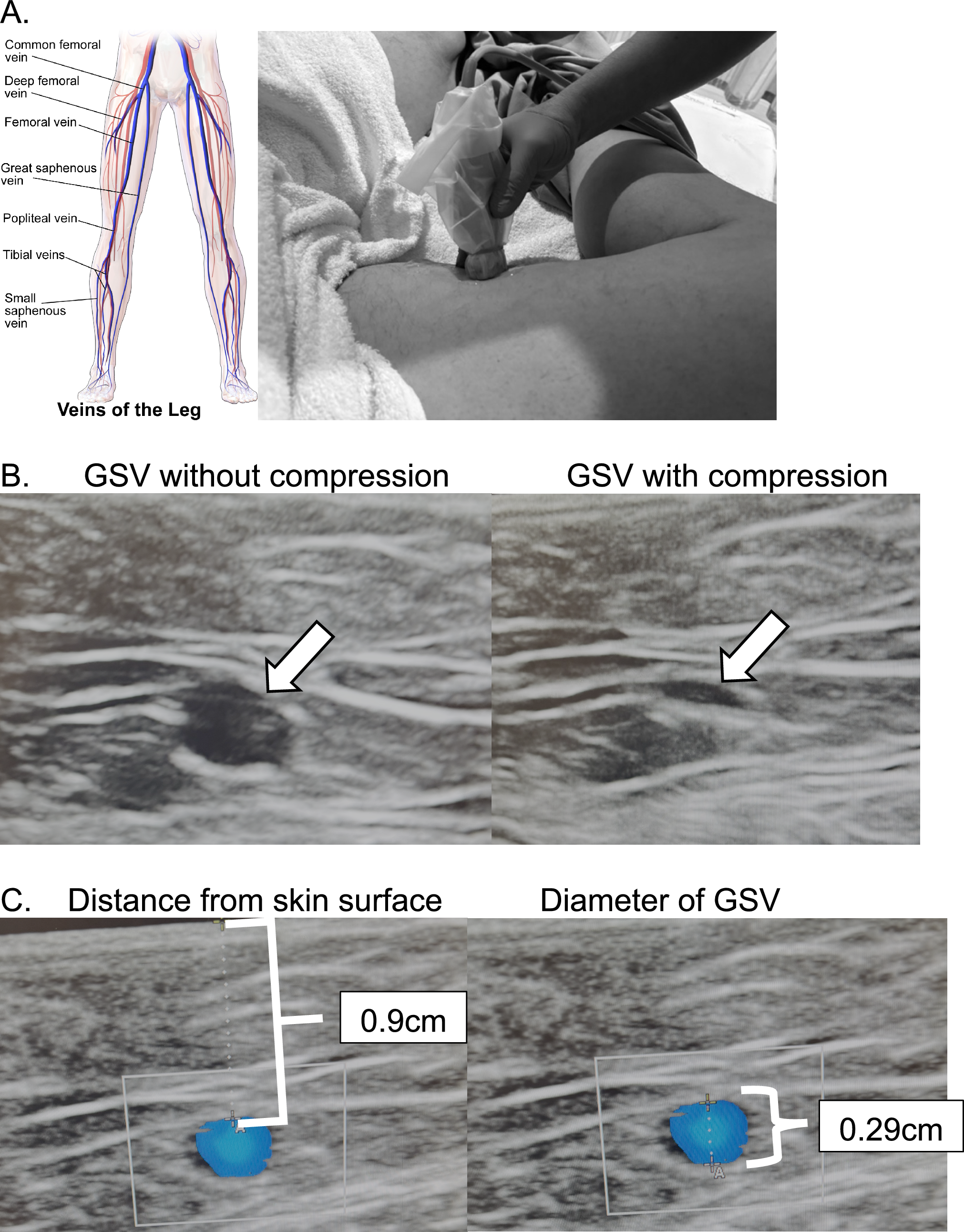 Lower vs upper extremity injection of agitated saline for identification of patent foramen ovale (LOCATE)