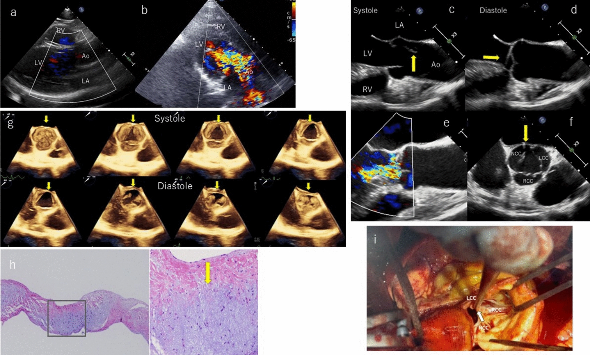 A case of acute severe aortic regurgitation due to aortic valve commissure avulsion