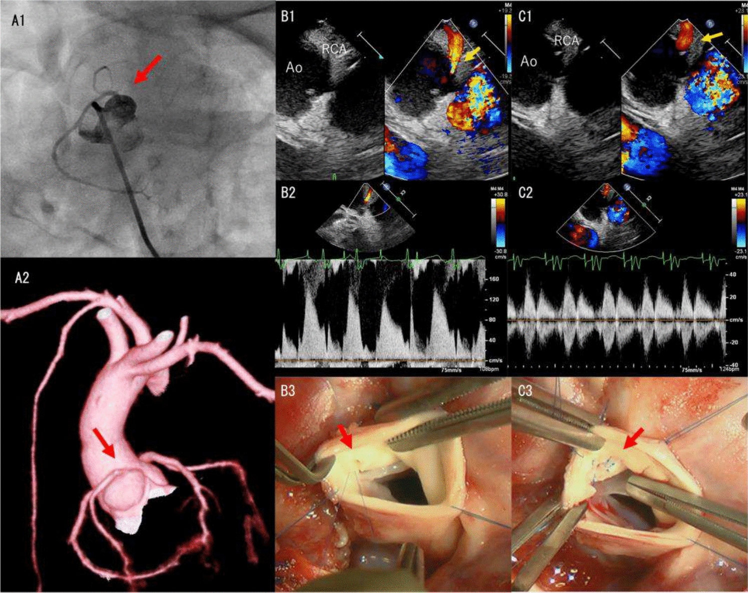 The usefulness of color Doppler images using epicardial echocardiography for diagnosis of coronary artery ostial stenosis in an infant