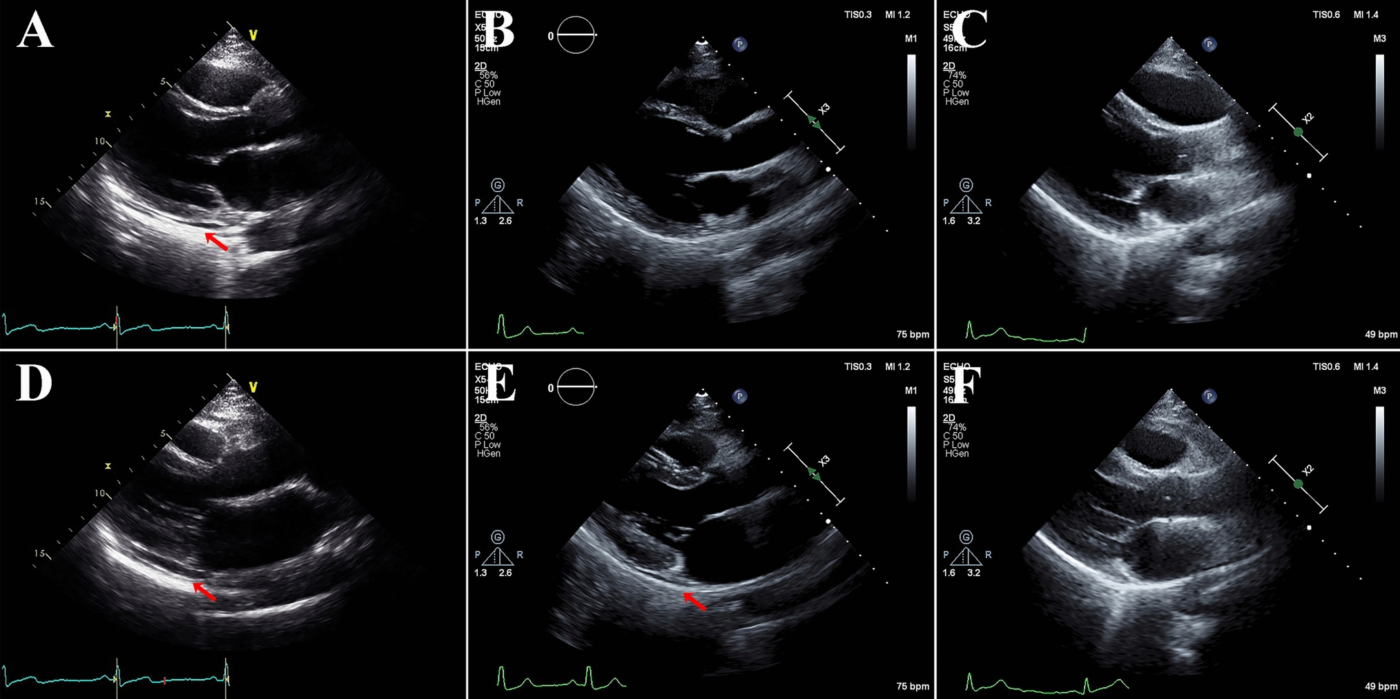 The implication of pericardial effusion in the third trimester for preeclampsia and heart failure in high-risk pregnant women
