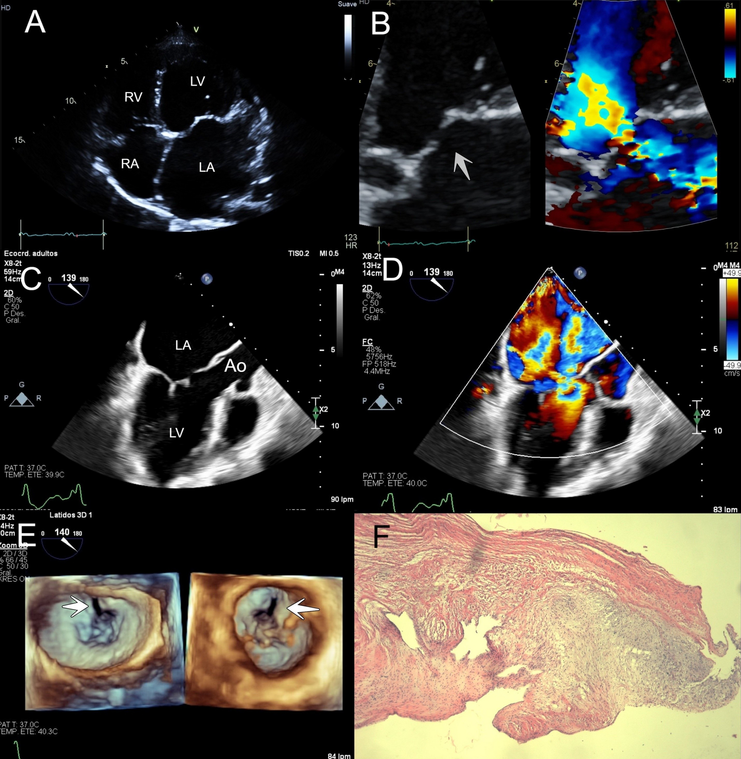 Isolated mitral valve perforation in a middle aged-woman