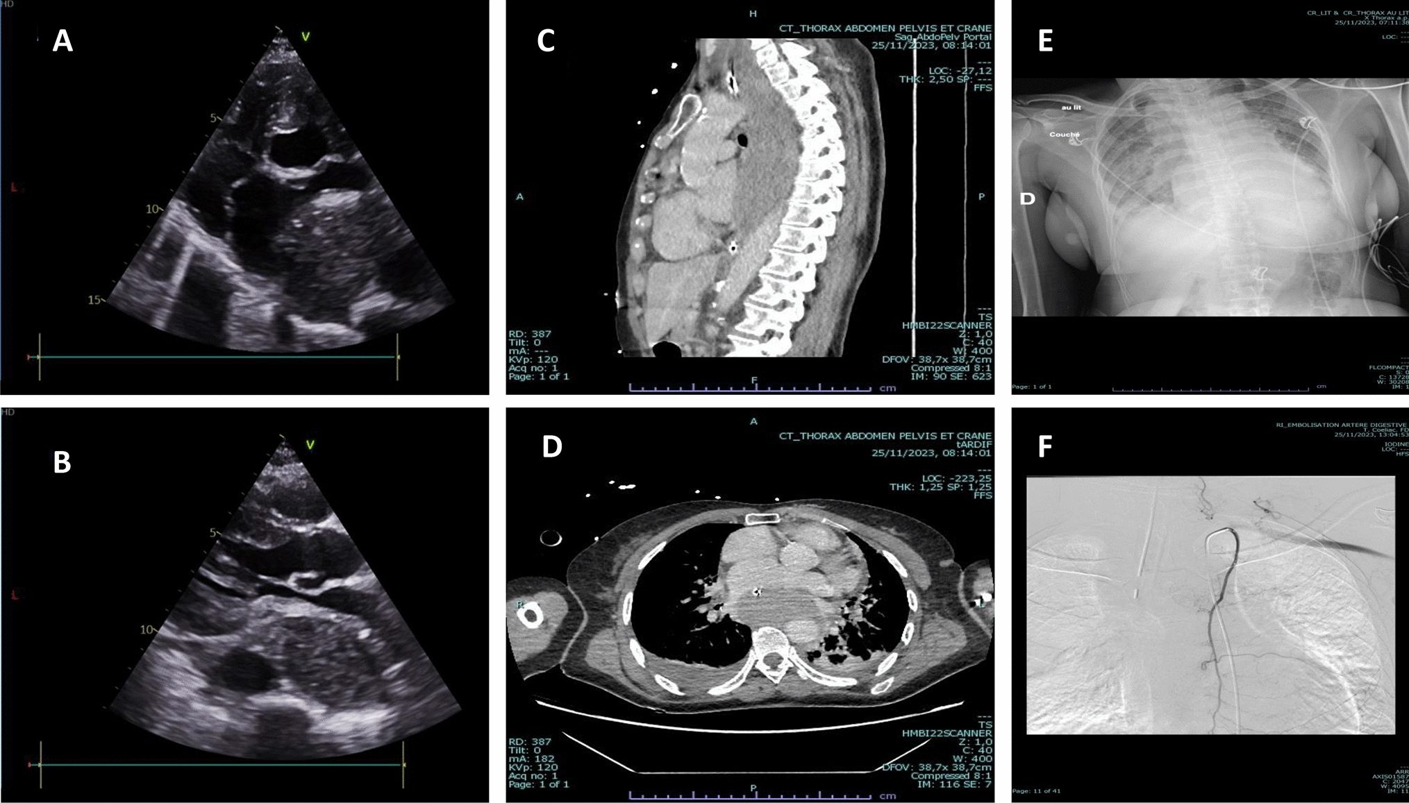 Extrinsic left atrium compression due to intramural esophageal hematoma after TEE for catheter AF ablation mimicking tamponade