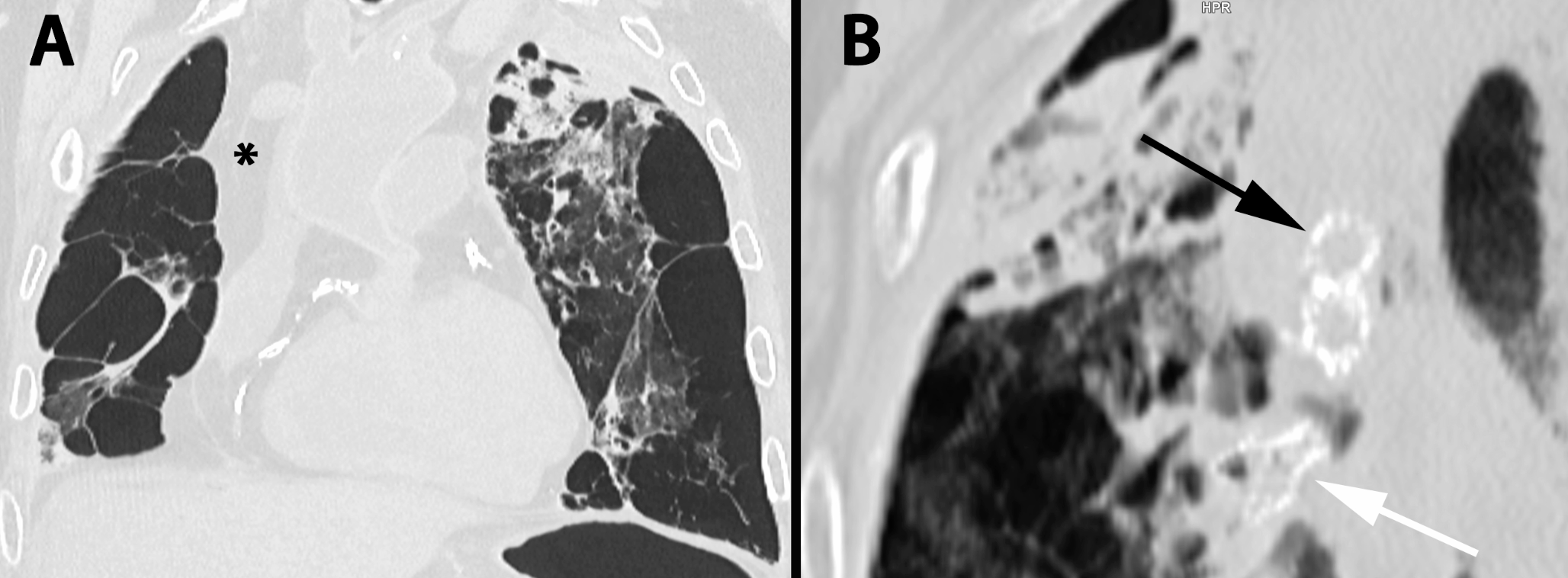 Endobronchial valves– an iatrogenic cause of hemoptysis to be considered at autopsy