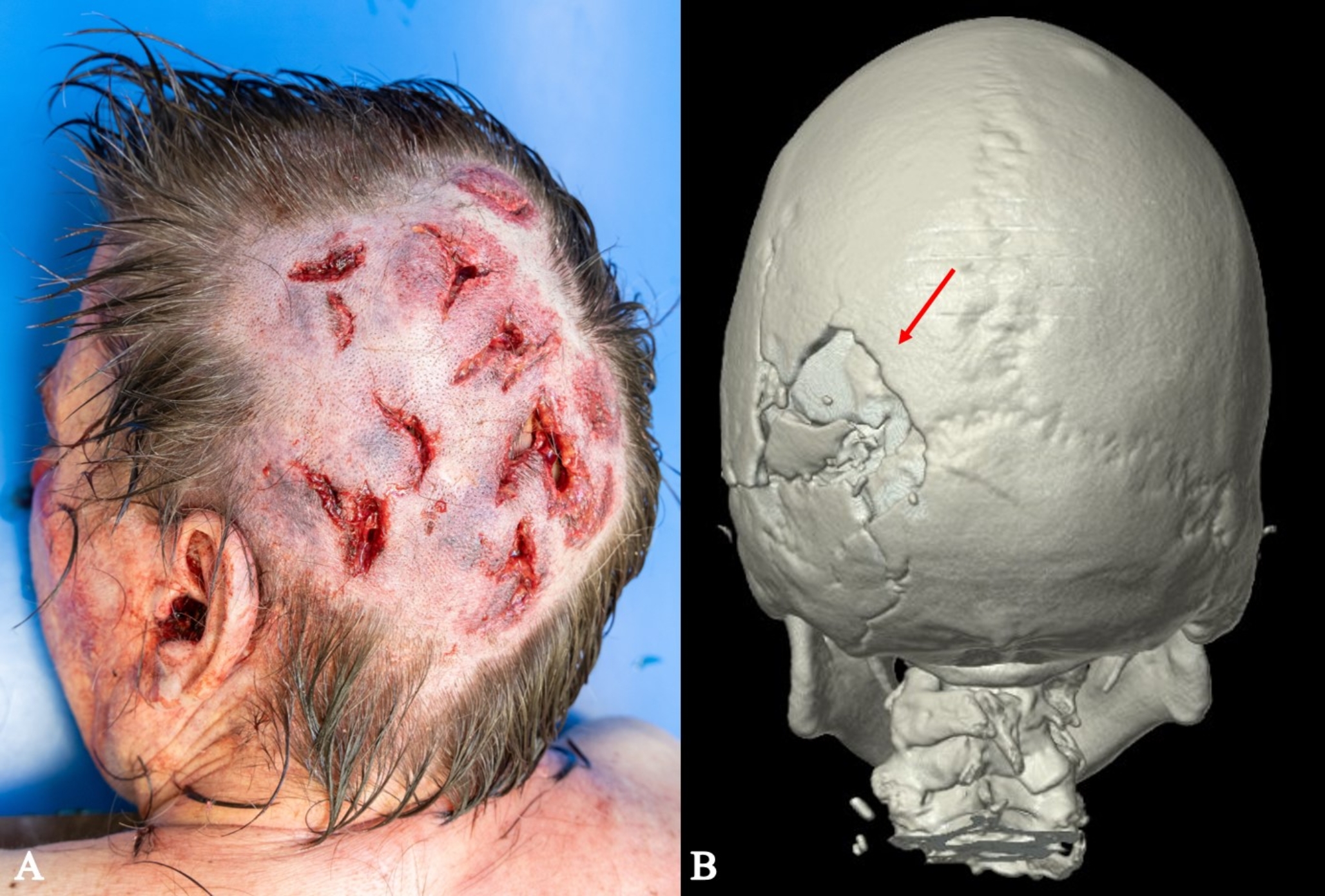 The issue of “combined homicide”: a review of the literature and an explanatory case including blunt force trauma, strangulation and stab wounds