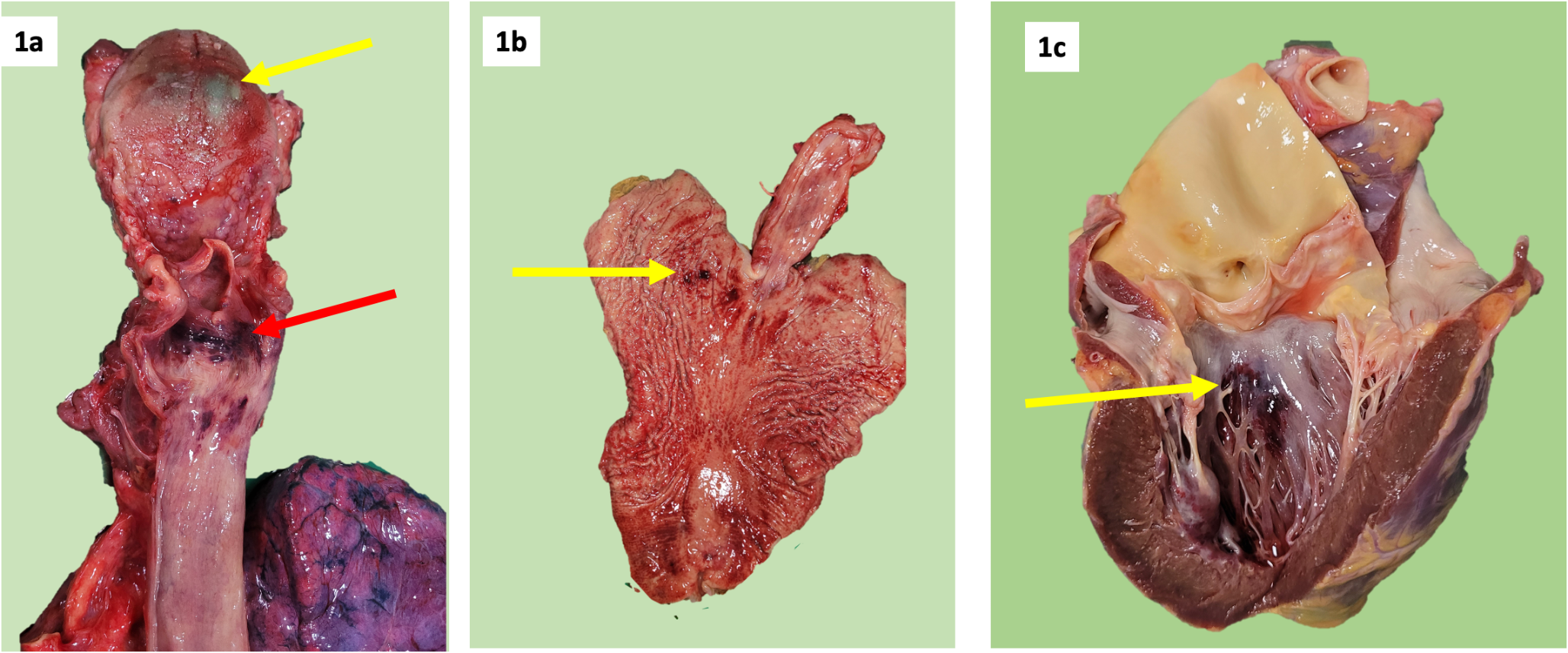 A rare case of lethal lactic acid poisoning: an autopsy case report