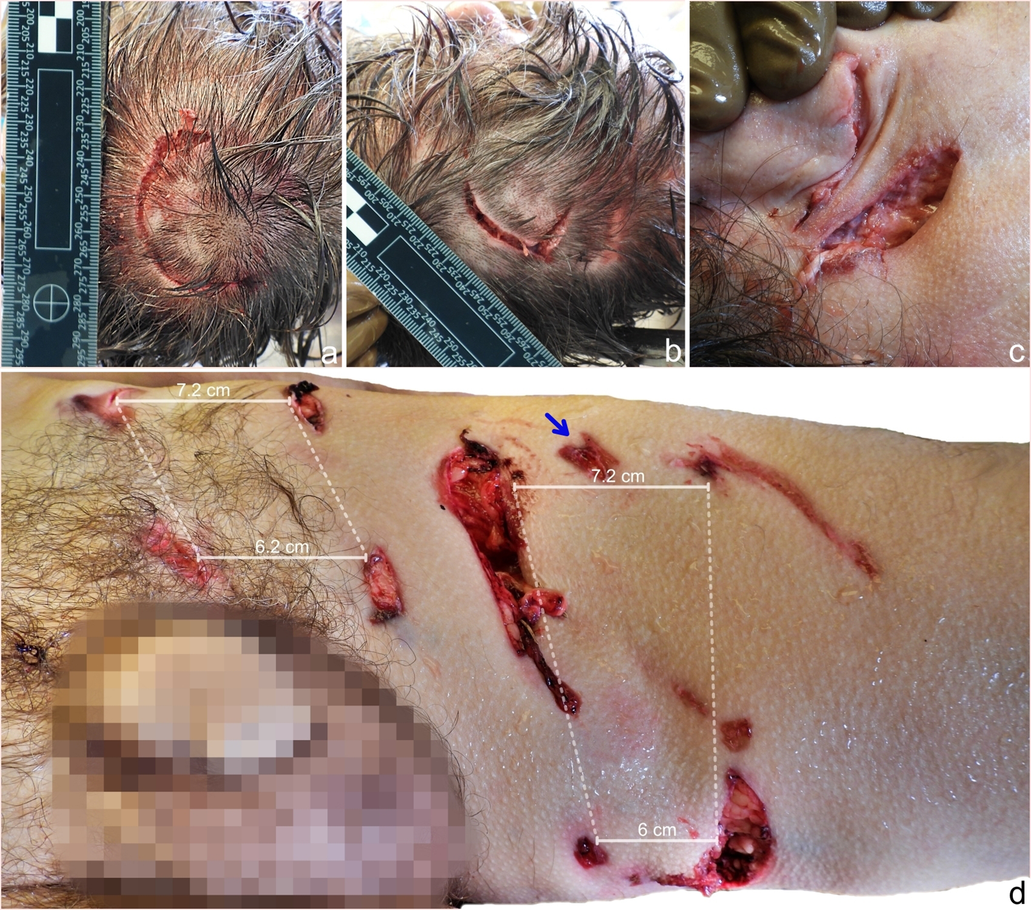 Claws and canines: injury patterns following European brown bear attacks