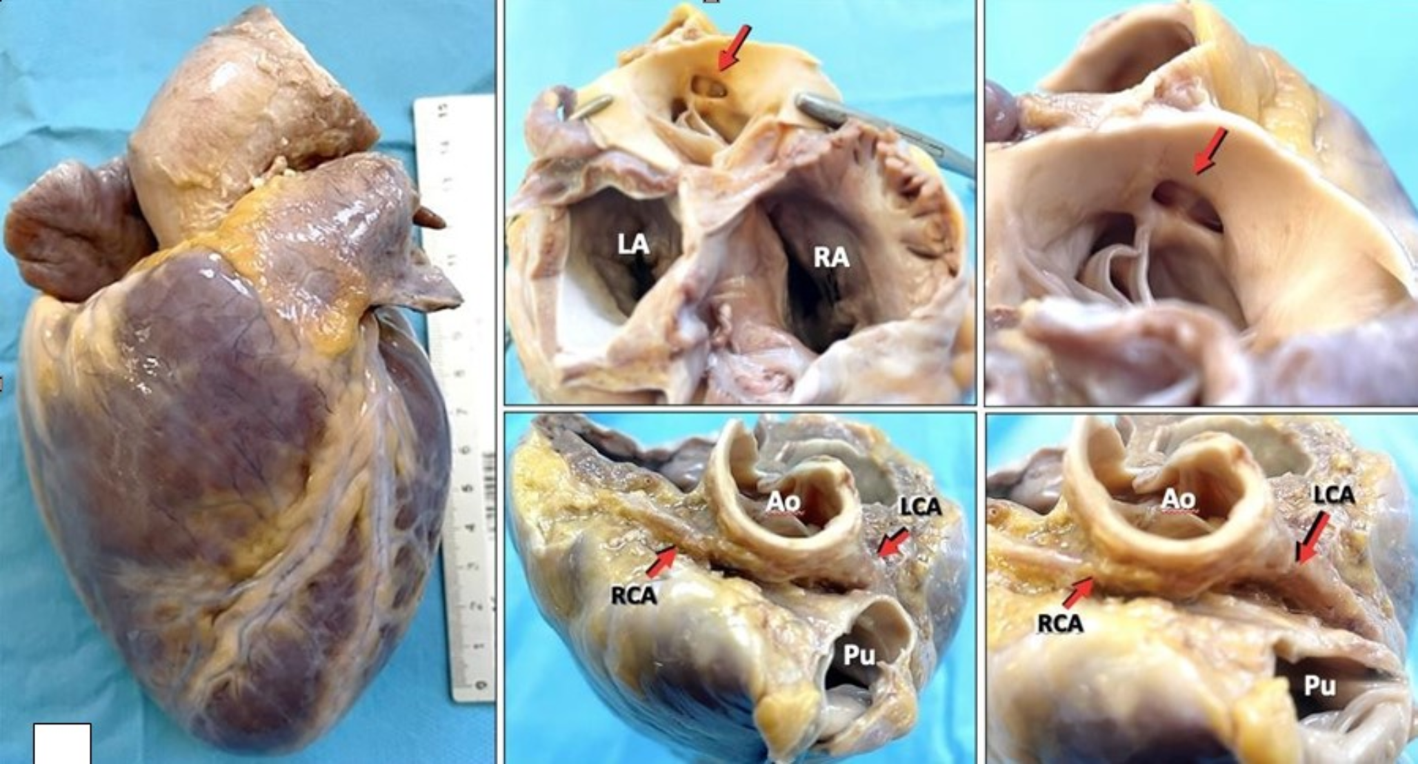 Sudden cardiac death in a young athlete due to anomalous origin of both coronaries from a common ostium