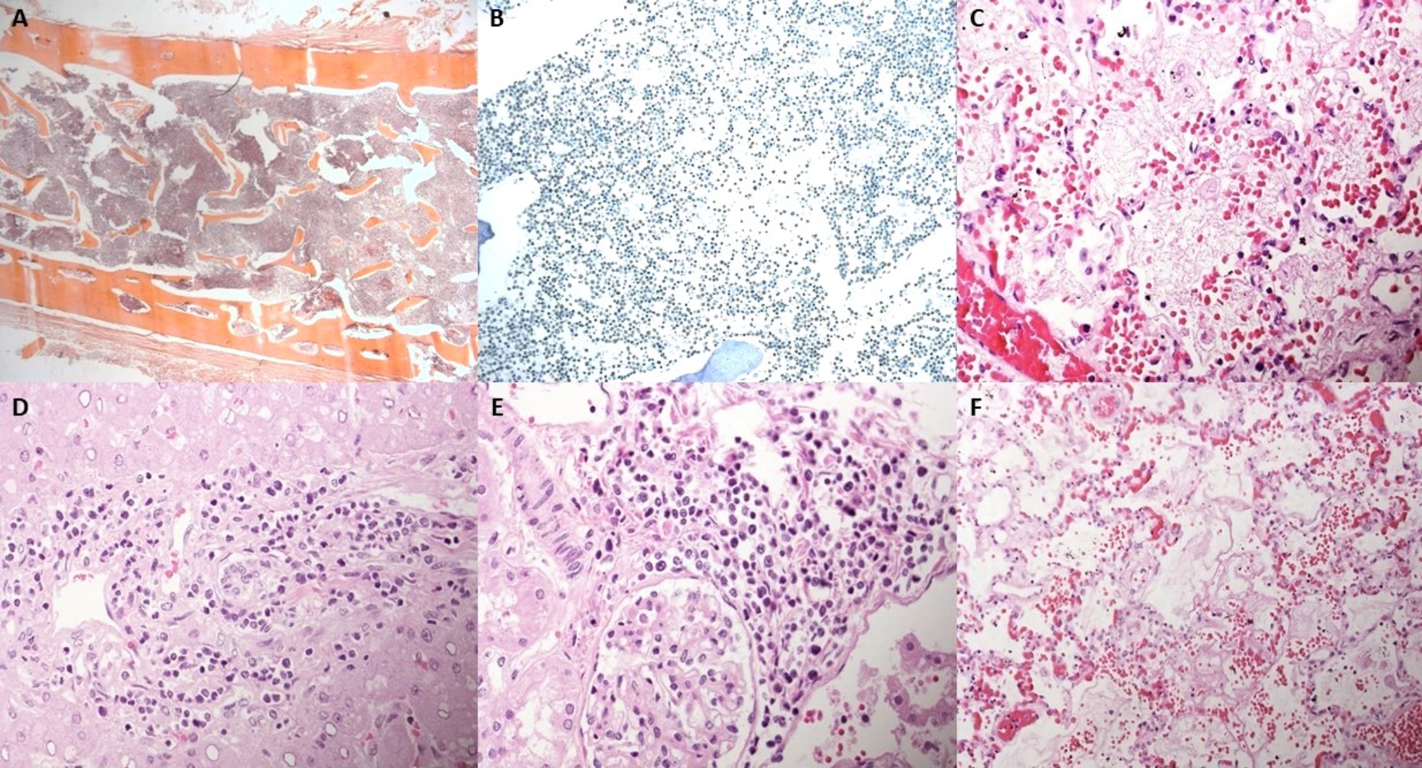 Sudden unexpected death due to B-cell acute lymphocytic leukaemia (B-ALL) in a 3-year-old child