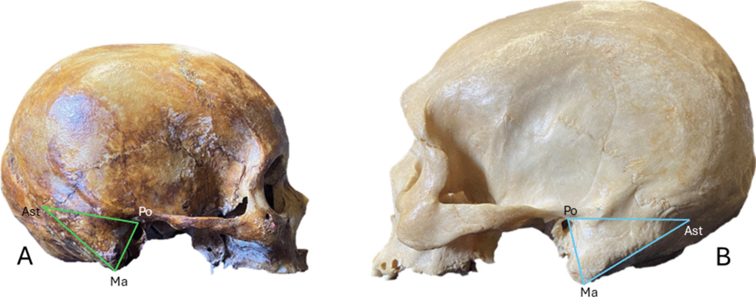 The mastoid triangle (Ma-Ast-Po) as a sexually dimorphic feature – a systematic review of 1604 human skulls and meta-analysis