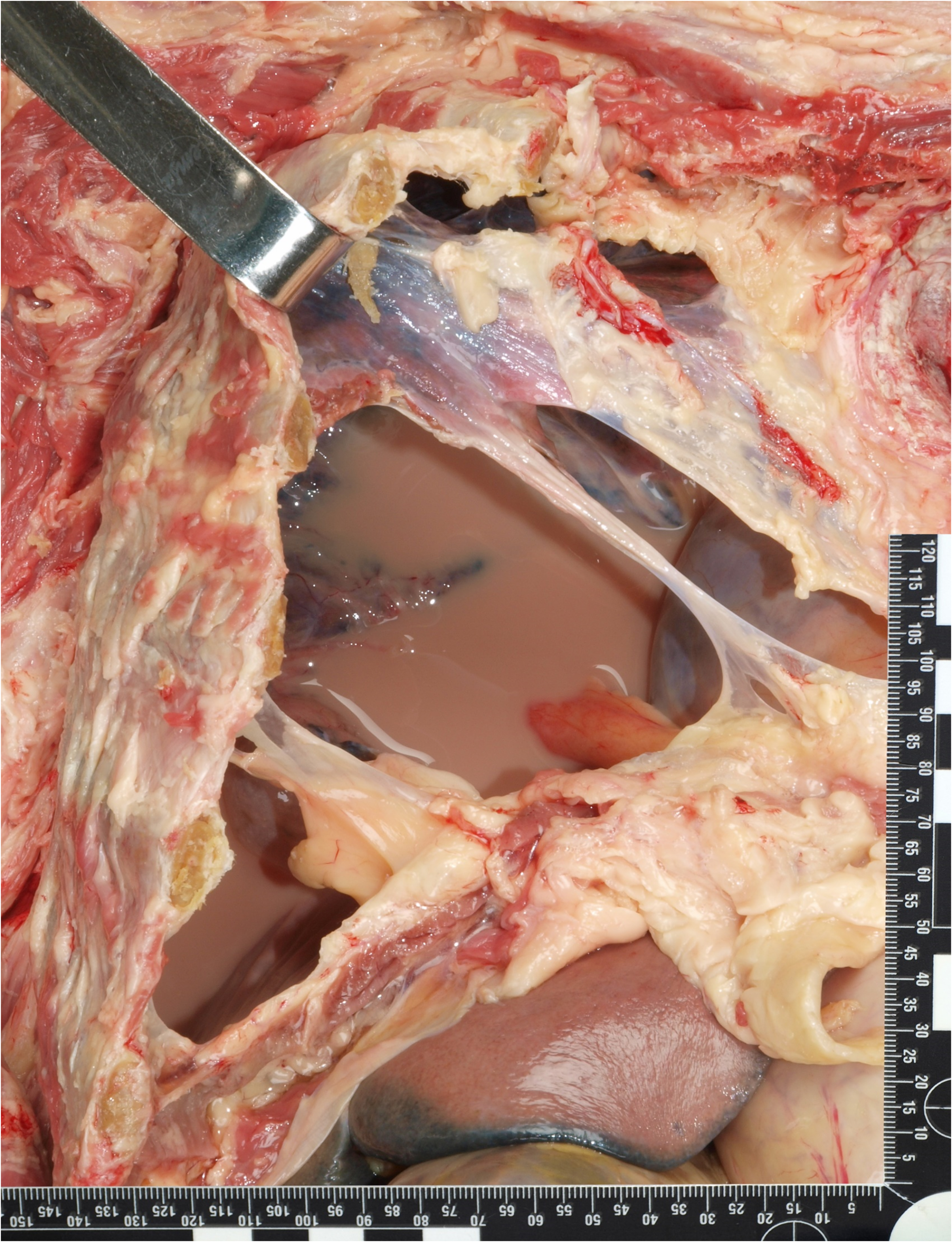 An alternative method to differentiate pleural effusion after leakage of artificial enteral nutrition formula