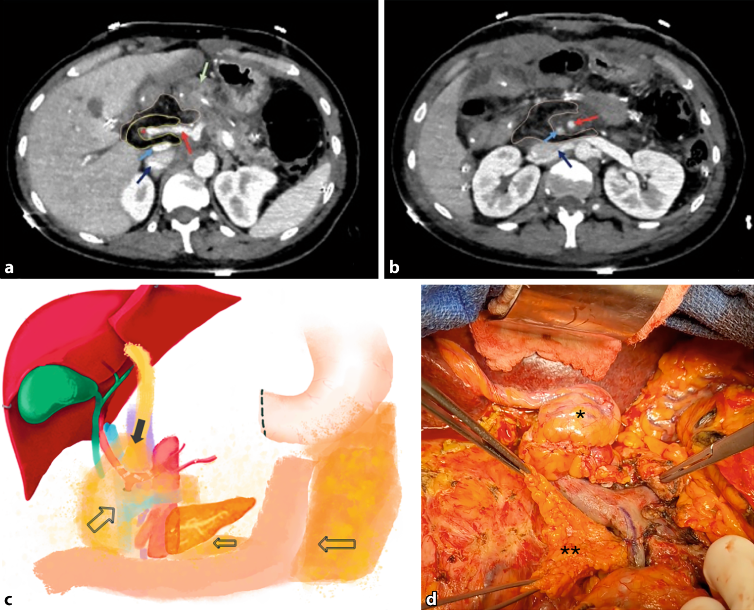 Techniques for falciform/round ligament wrapping and omental flap application for gastroduodenal artery stump and mesenteric vessel management during pancreaticoduodenectomy to prevent clinically relevant delayed post-pancreatectomy hemorrhage: a step-by-step guide with video