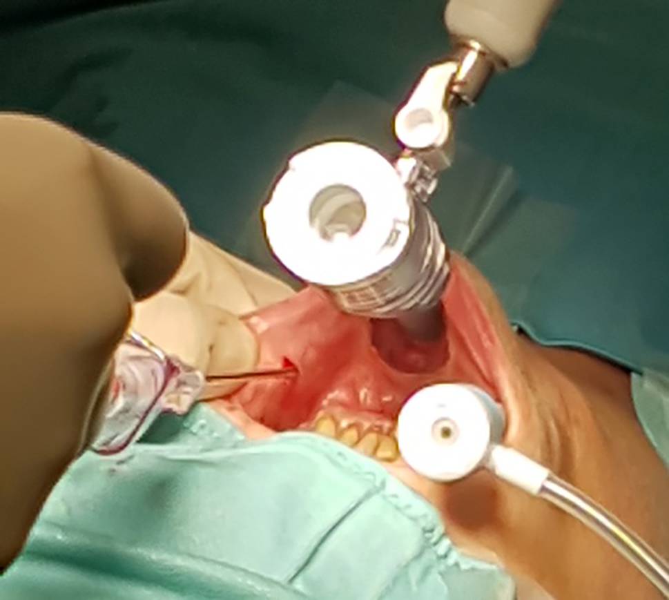 Transoral parathyroidectomy in primary hyperparathyroidism—initial results of the European TOETVA/TOEPVA Study Group