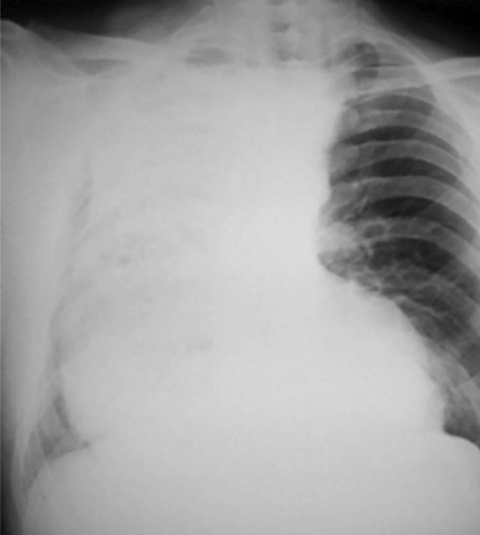 End-stage achalasia presenting as acute respiratory failure: a case report and review of the literature