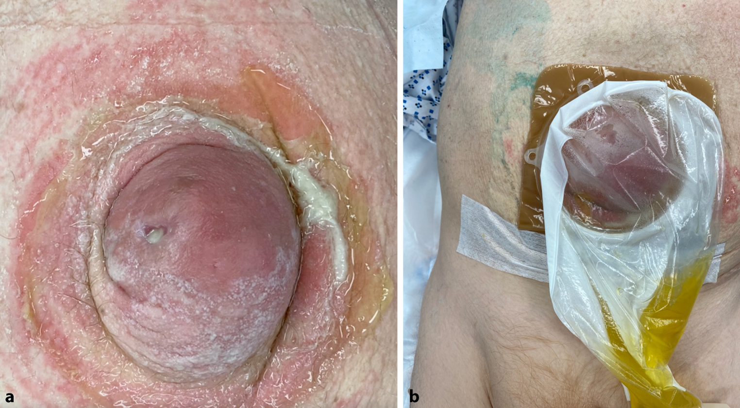 Dancing with medusae—umbilical and ventral hernia repair in patients with cirrhosis
