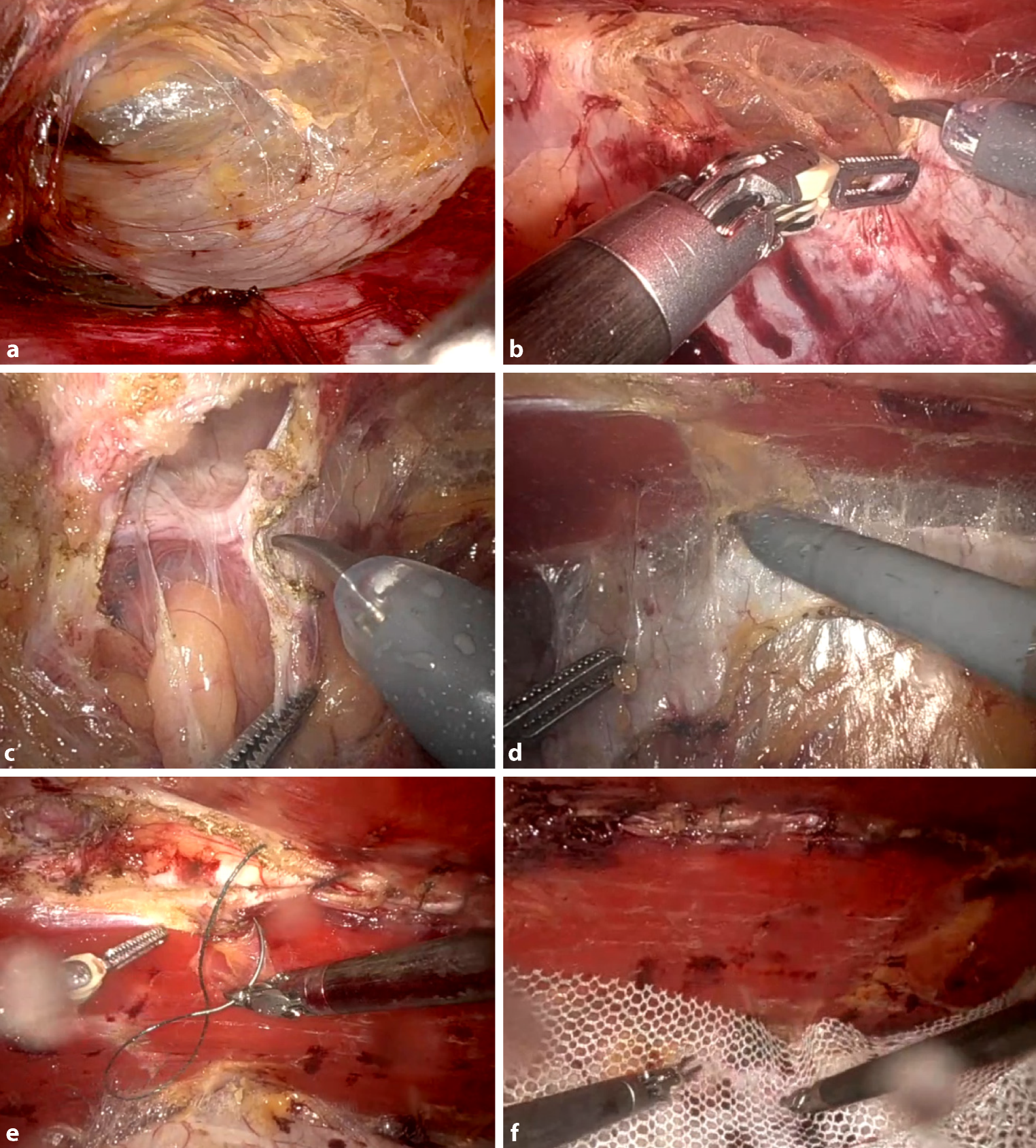 Robotic enhanced-view totally extraperitoneal repair with endoscopic posterior linea alba reconstruction and retromuscular mesh for midline incisional hernias: a registry-based analysis of 40 consecutive patients