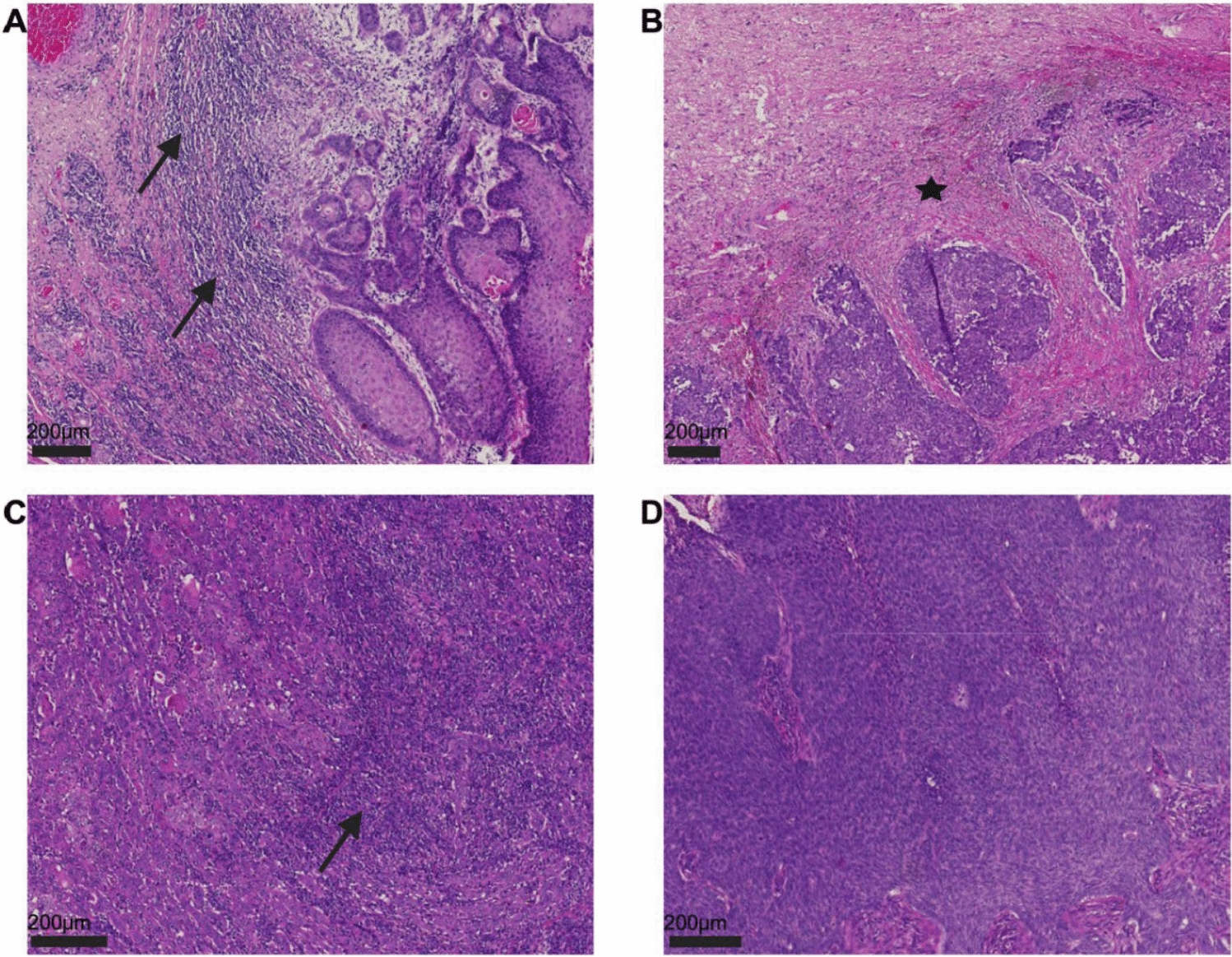 Histopathological biomarkers in squamous cell carcinoma of the vulva: the prognostic relevance of tumor-infiltrating lymphocytes (TILs)—a retrospective study of 157 cases