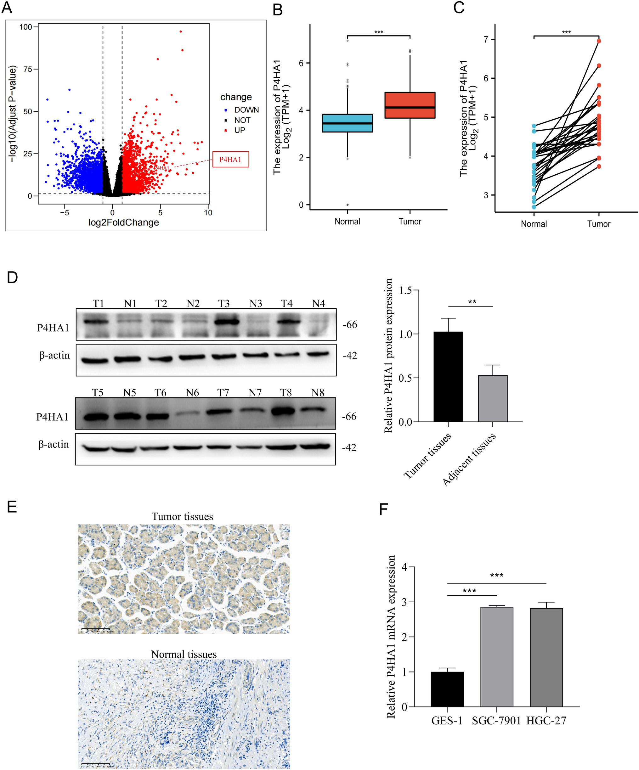 P4HA1 is highly expressed in gastric cancer and promotes proliferation and metastasis of gastric cancer cells
