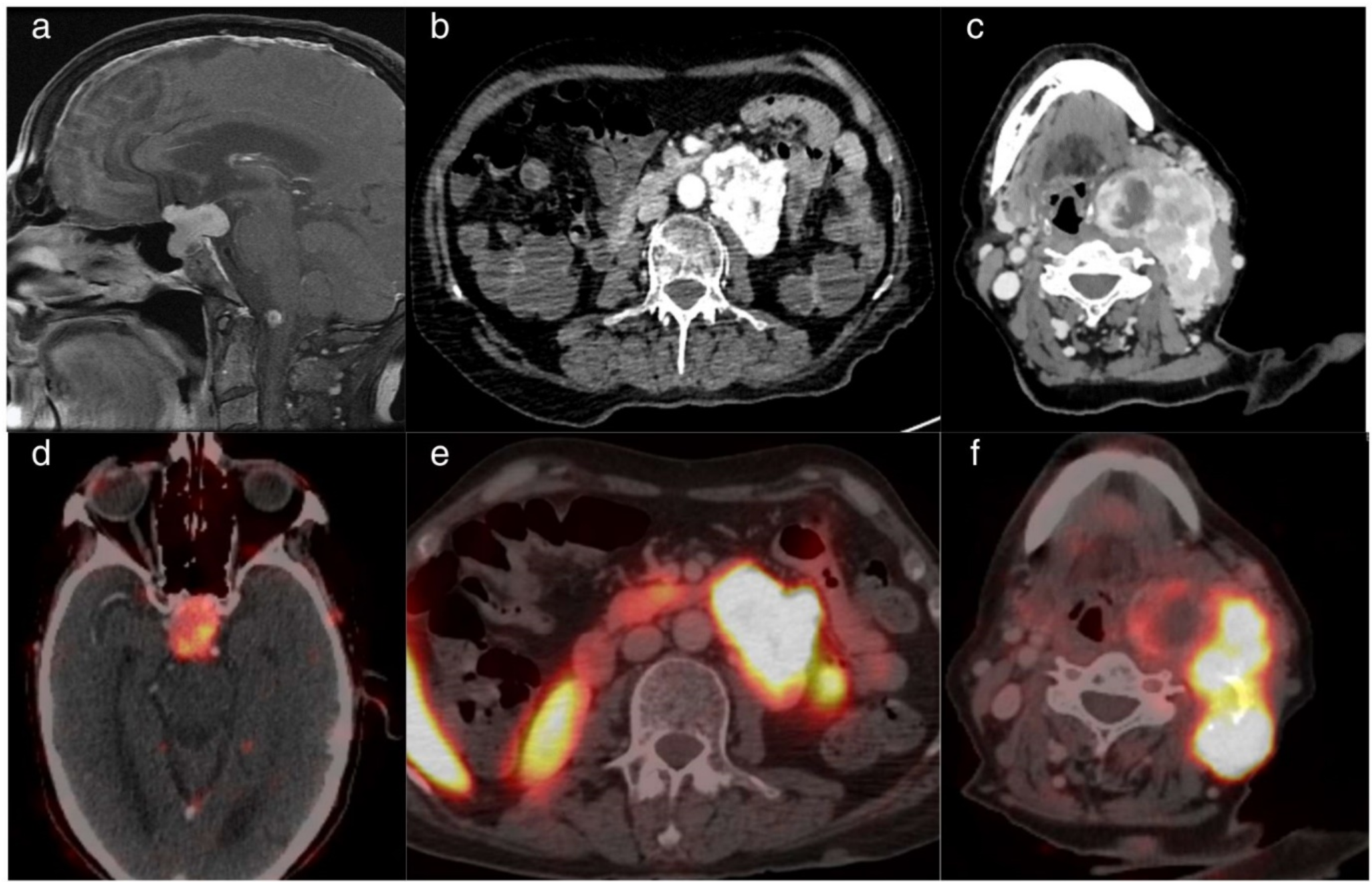 3P association and the evolving significance of succinate dehydrogenase (SDHB) mutation in pituitary adenomas