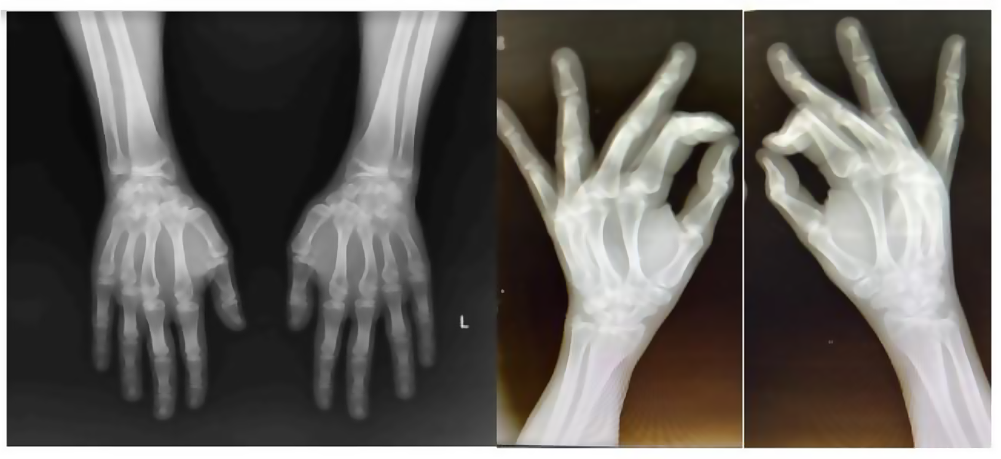Aromatase enzyme deficiency in an adult male patient and the effects of estrogen replacement therapy: a rare cause of tall stature