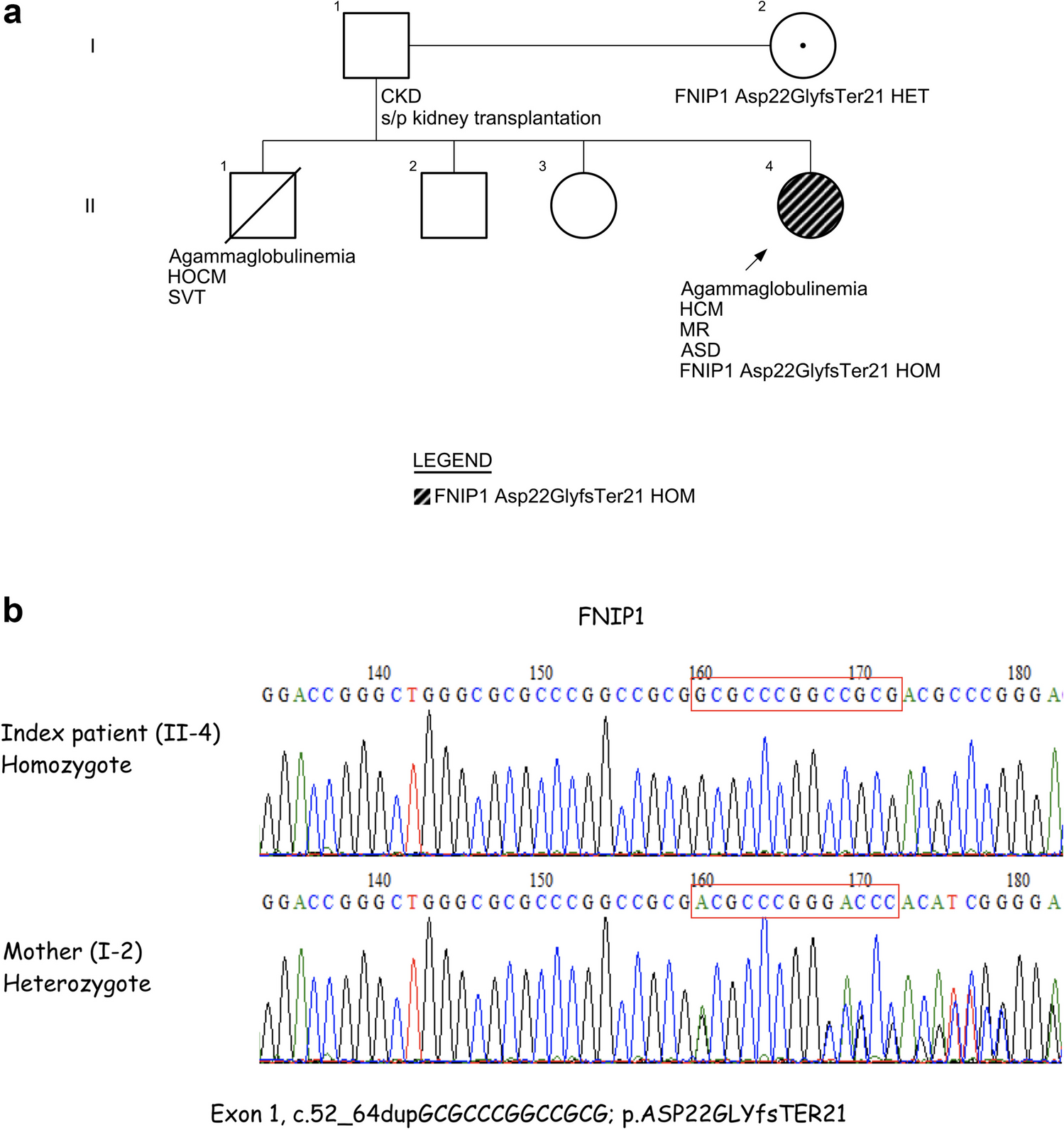 A novel mutation in  associated with a syndromic immunodeficiency and cardiomyopathy