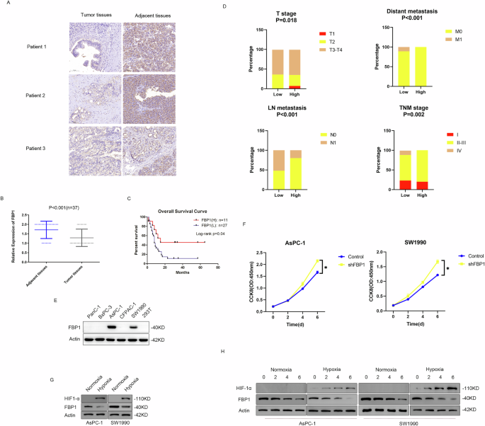 O-GlcNAcylation of FBP1 promotes pancreatic cancer progression by facilitating its Lys48-linked polyubiquitination in hypoxic environments