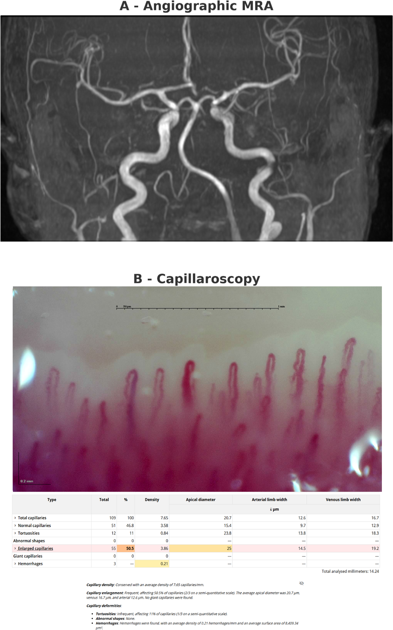 Microvascular and cerebrovascular alterations in Raynaud’s phenomenon and fibromyalgia