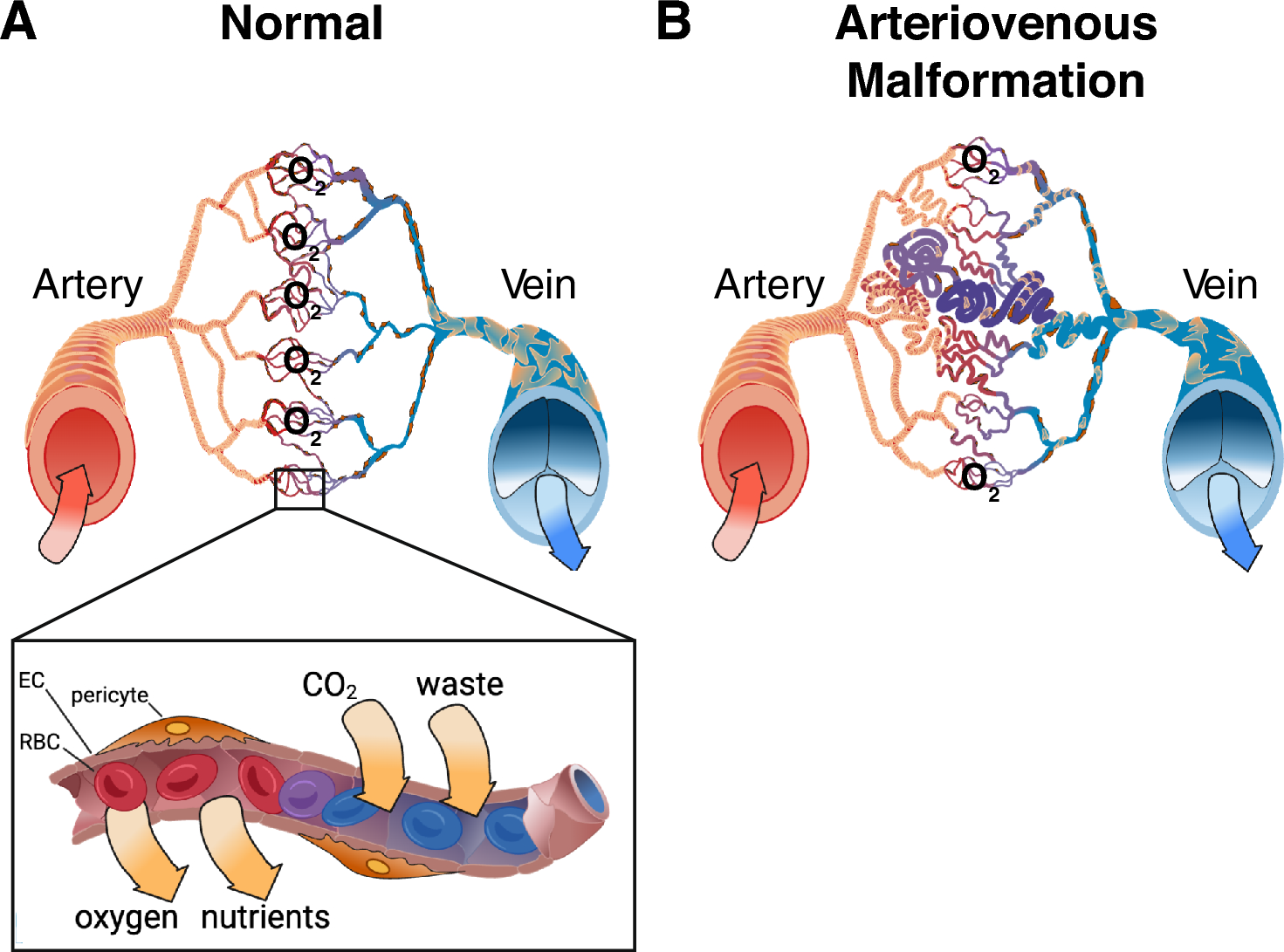 From bench to bedside: murine models of inherited and sporadic brain arteriovenous malformations