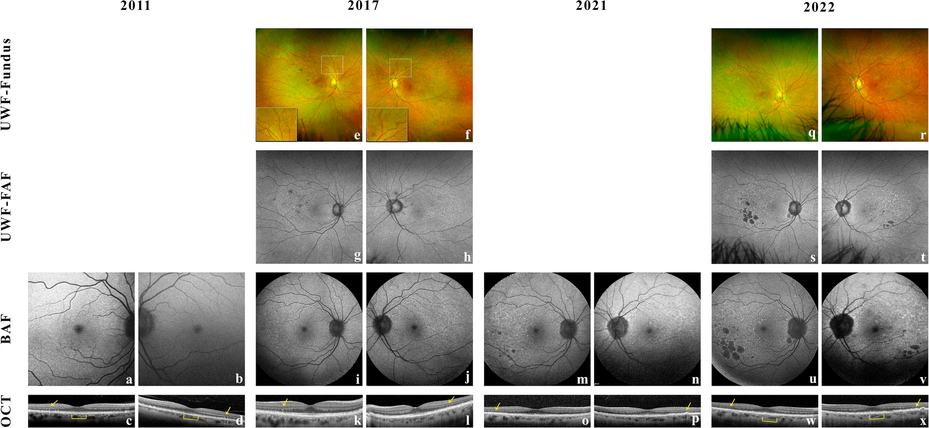 An incipient late-onset retinal degeneration with a C1QTNF5 mutation: a case report with an 11-year follow-up