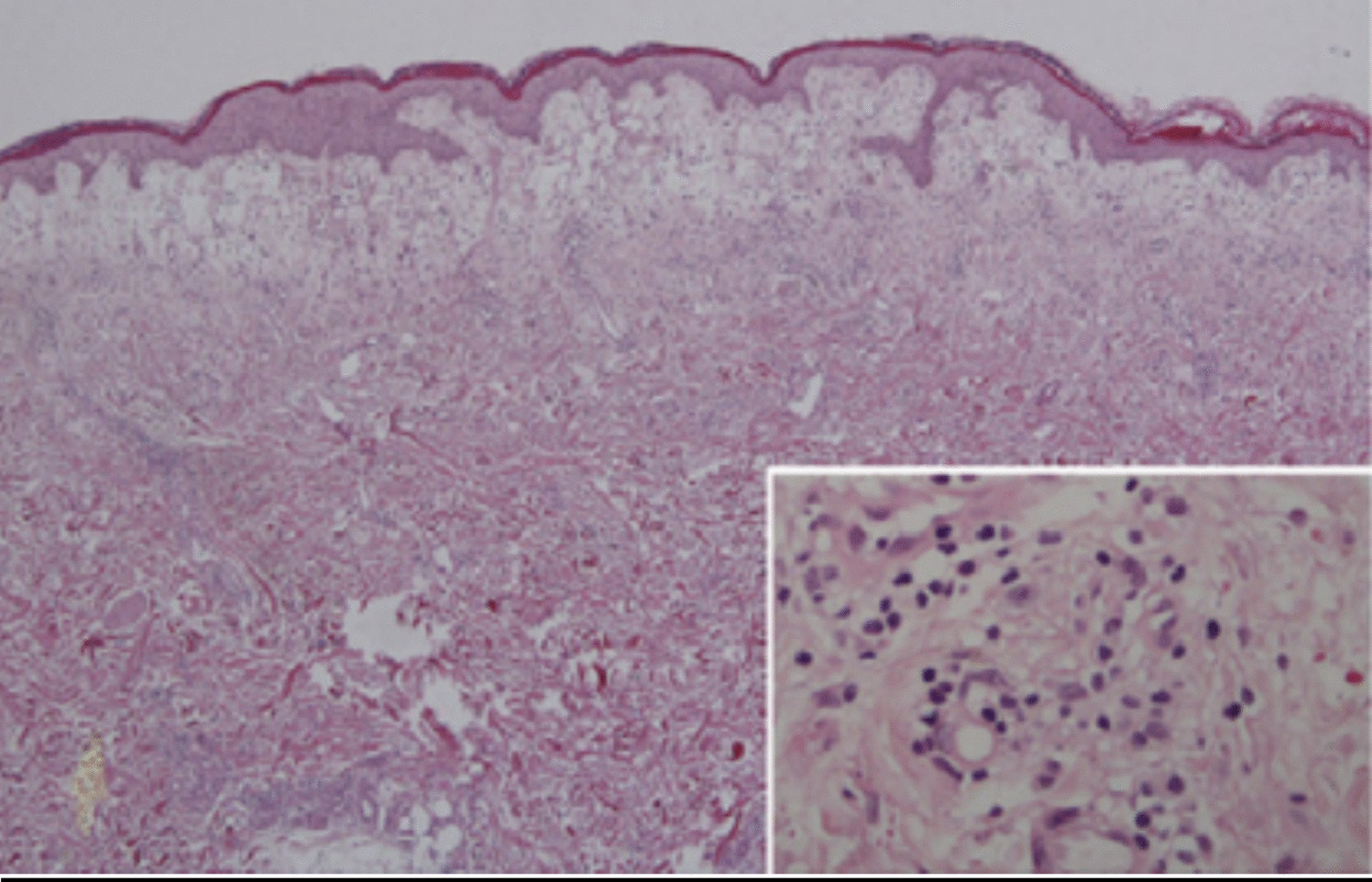 A Comprehensive Review of Sweet Syndrome focused on the Histiocytoid Variant