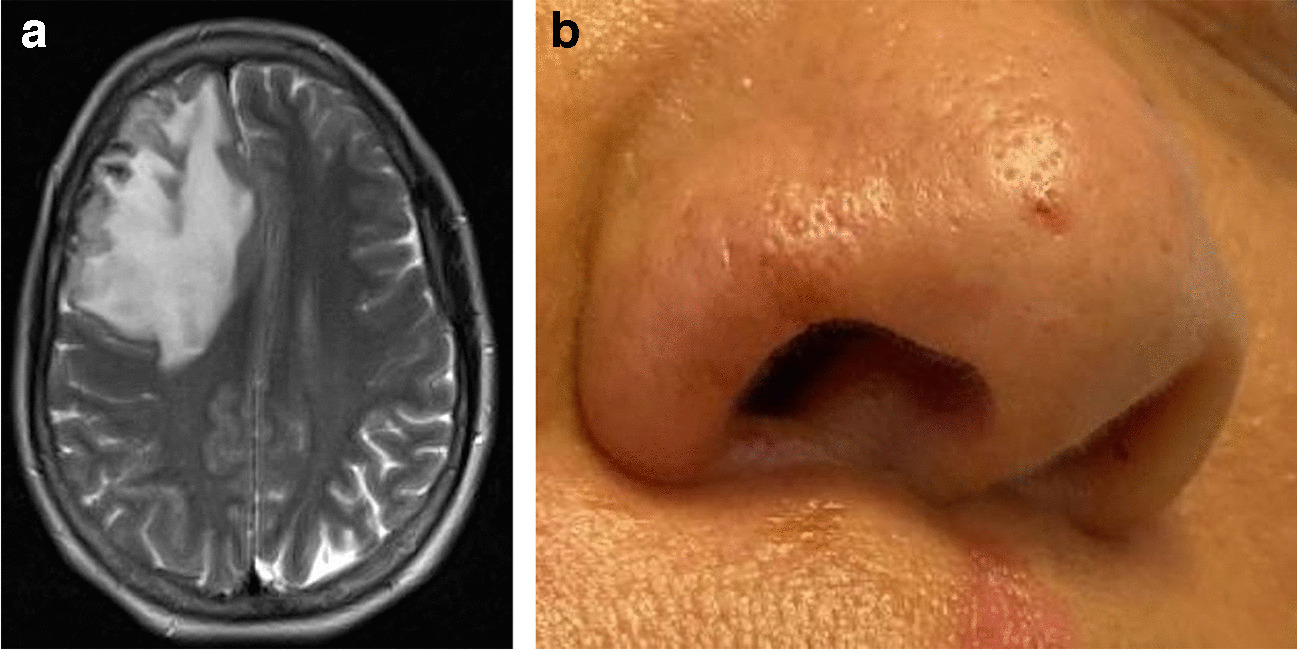 Sarcoidosis for the Inpatient Dermatologist