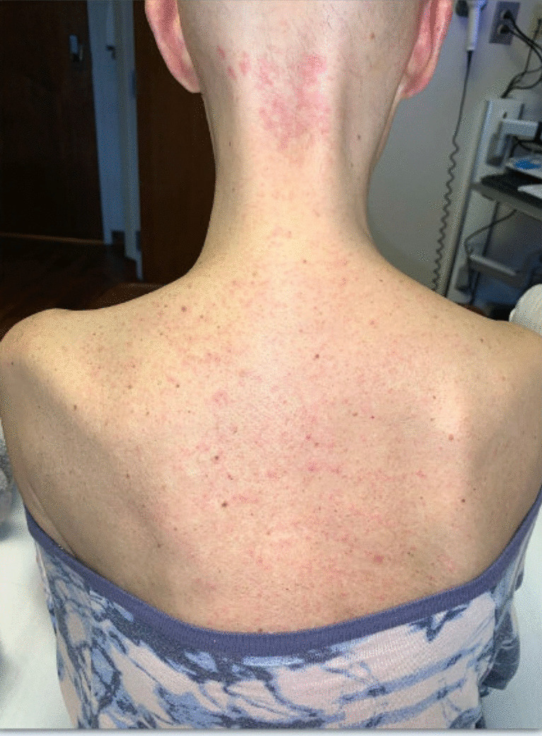 Acute Graft-Versus-Host Disease: Diagnostic Challenges and Multidisciplinary Management in the Inpatient Setting