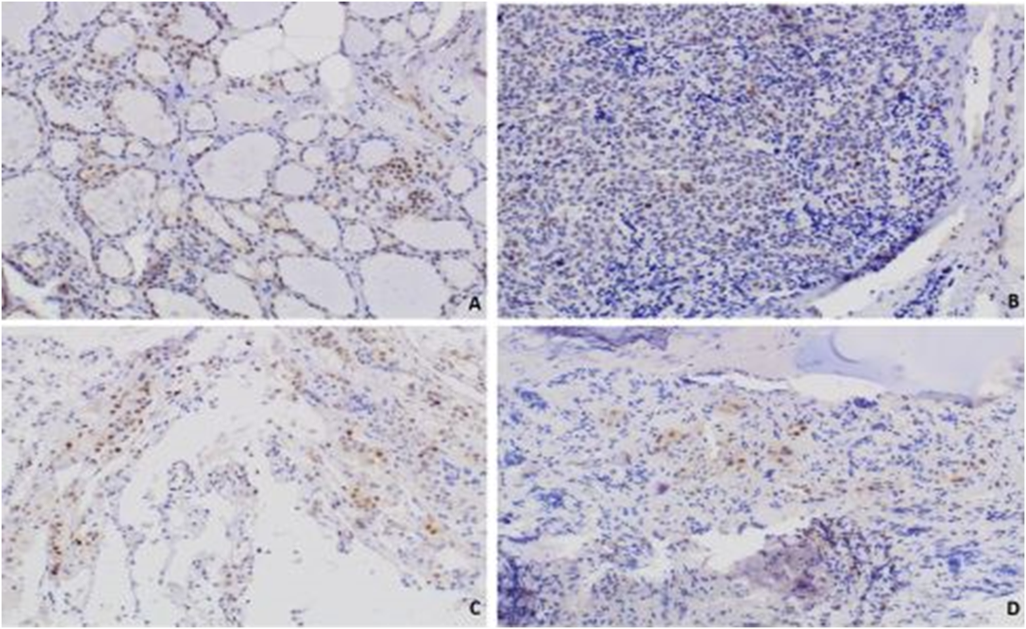 A novel likely pathogenic germline variant in  in a patient with MEN4 and medullary thyroid cancer