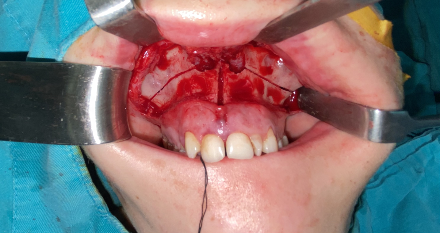 Evaluation of the density of the midpalatal suture after maxillary expansion: a comparative observational study