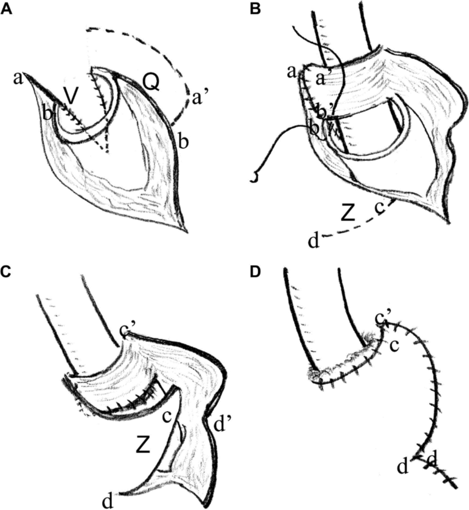 Continent Urinary Diversion for Neurogenic Lower Urinary Tract Dysfunction: a Review