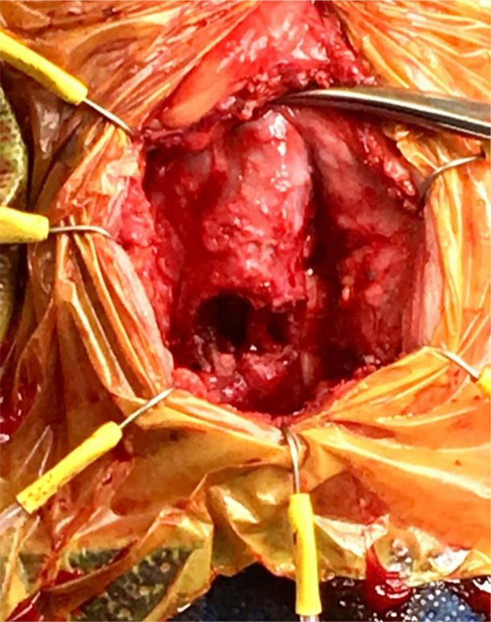 Surgical Management of Male Urinary Incontinence Following Radiation Therapy for Prostate Cancer: A Review