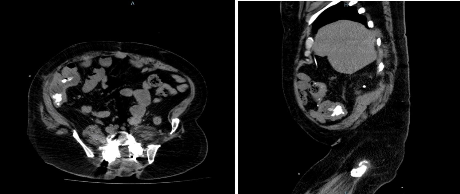Treating Staghorn Calculi in Those with Neurogenic Bladders—Special Considerations