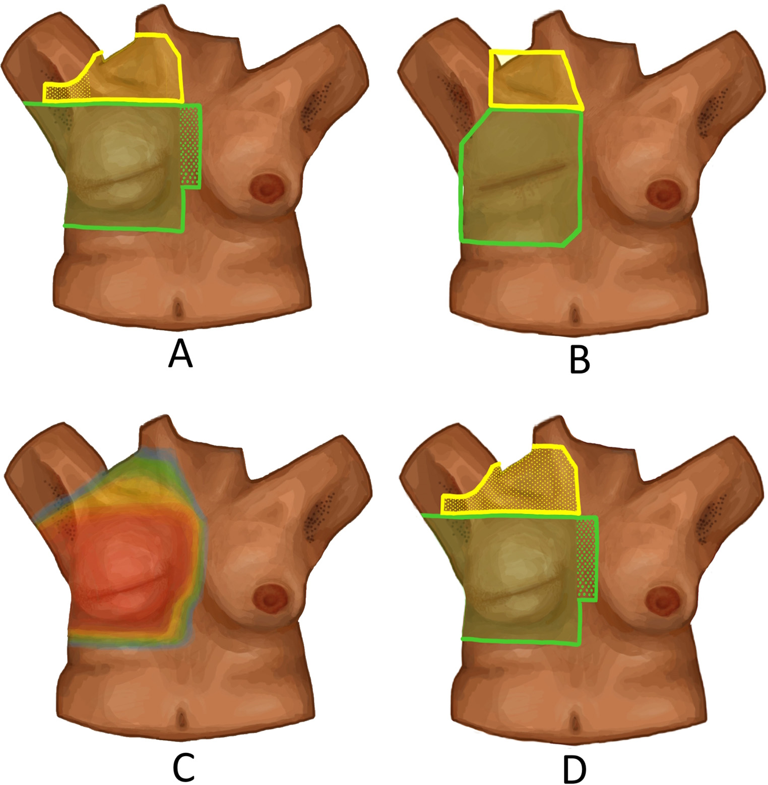 Modern-Day Hypofractionated Postmastectomy Radiation