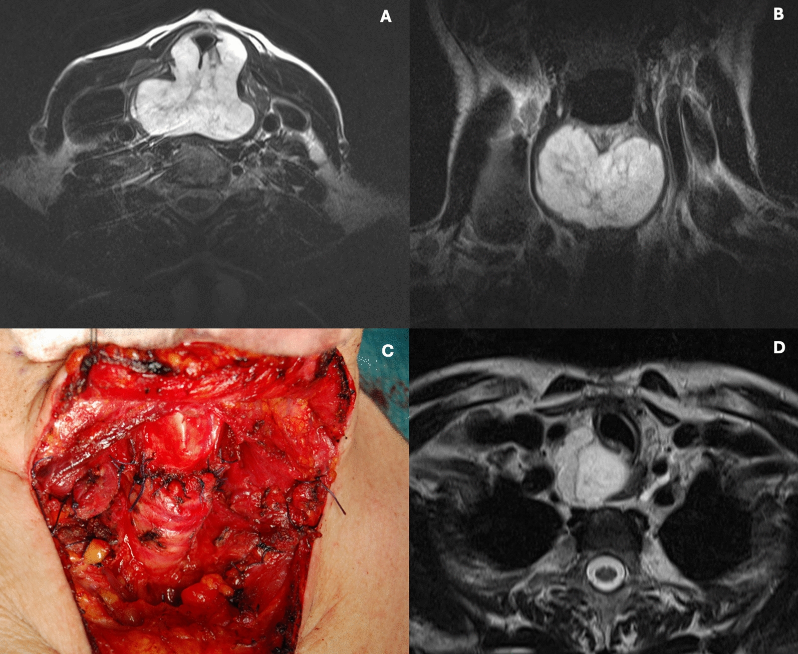 Aggressive Subtypes of Laryngeal Chondrosarcoma and their Clinical Behavior: A Systematic Review