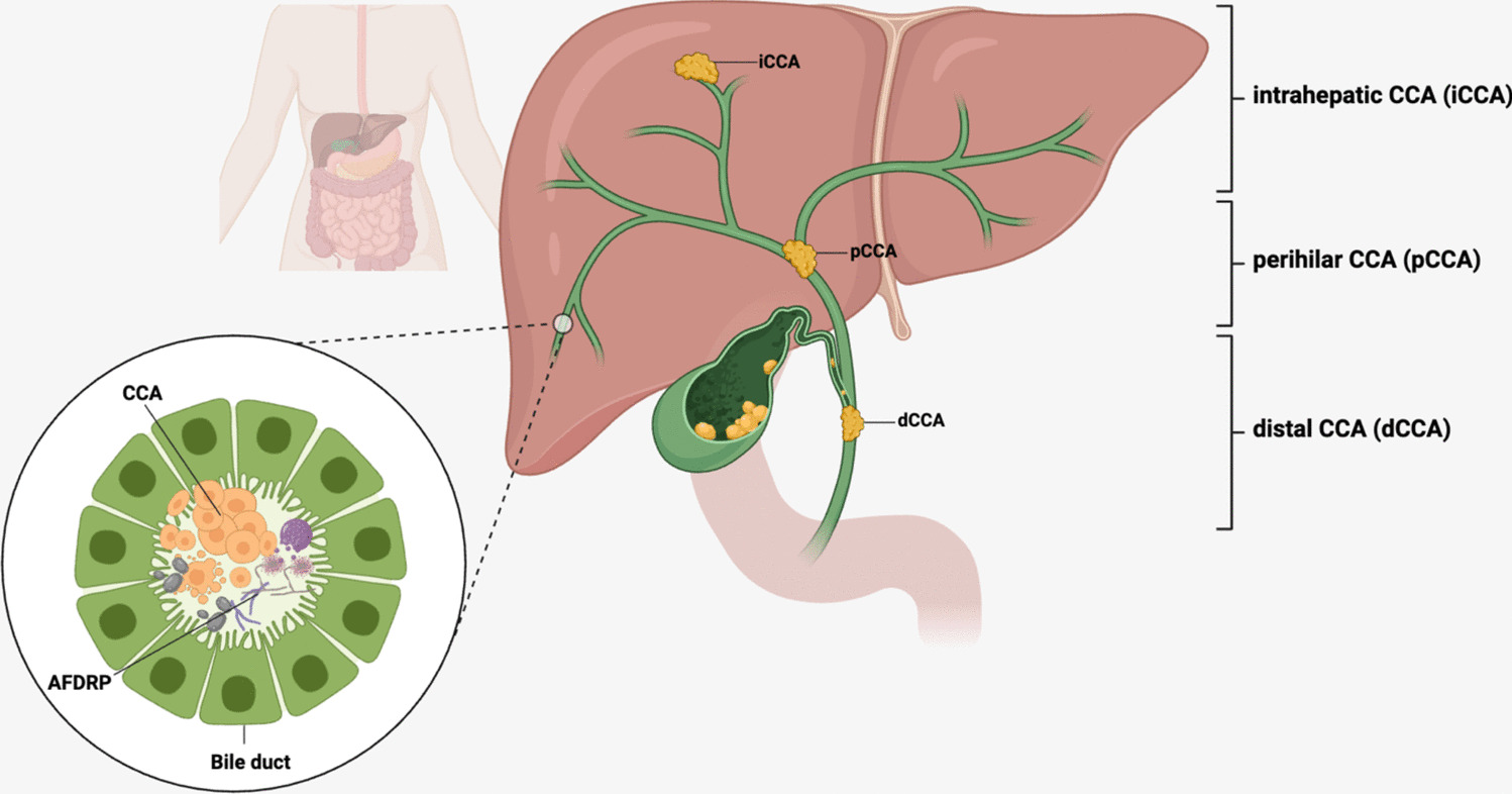 Potential Influence of Antifungal-drug Resistant Pathogens in Patients with Cholangiocarcinoma and the Application of Nanoparticle Mechanisms as Novel Antifungal and Anticancer Agents