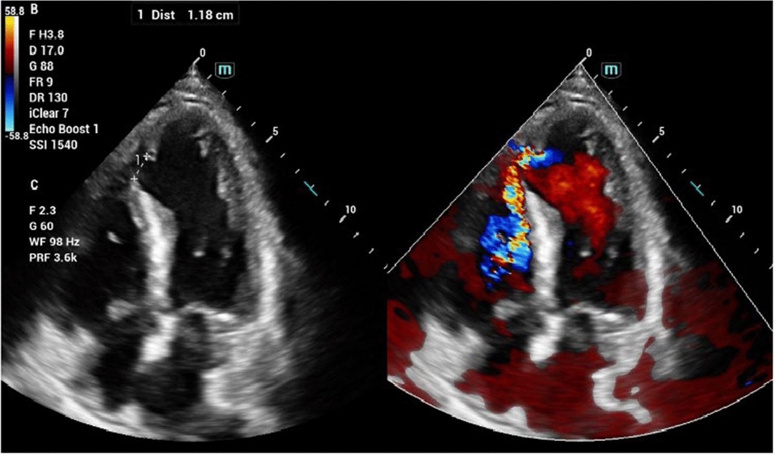 Transjugular approach percutaneous closure: a preferred solution for challenging surgical management of ventricular septal rupture