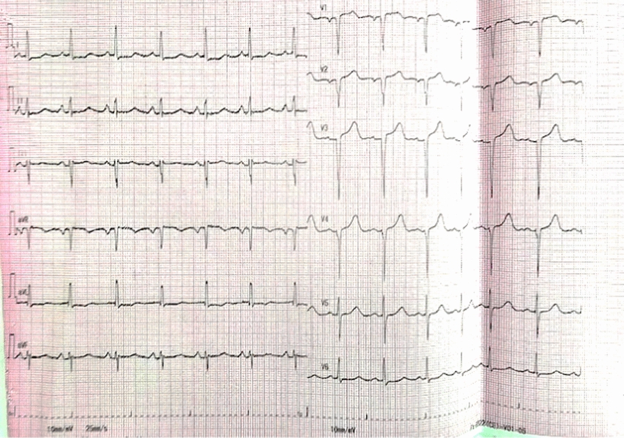 Alternative ‘block and delivery’ approach for alcohol septal ablation in hypertrophic cardiomyopathy with ischemia: a case report