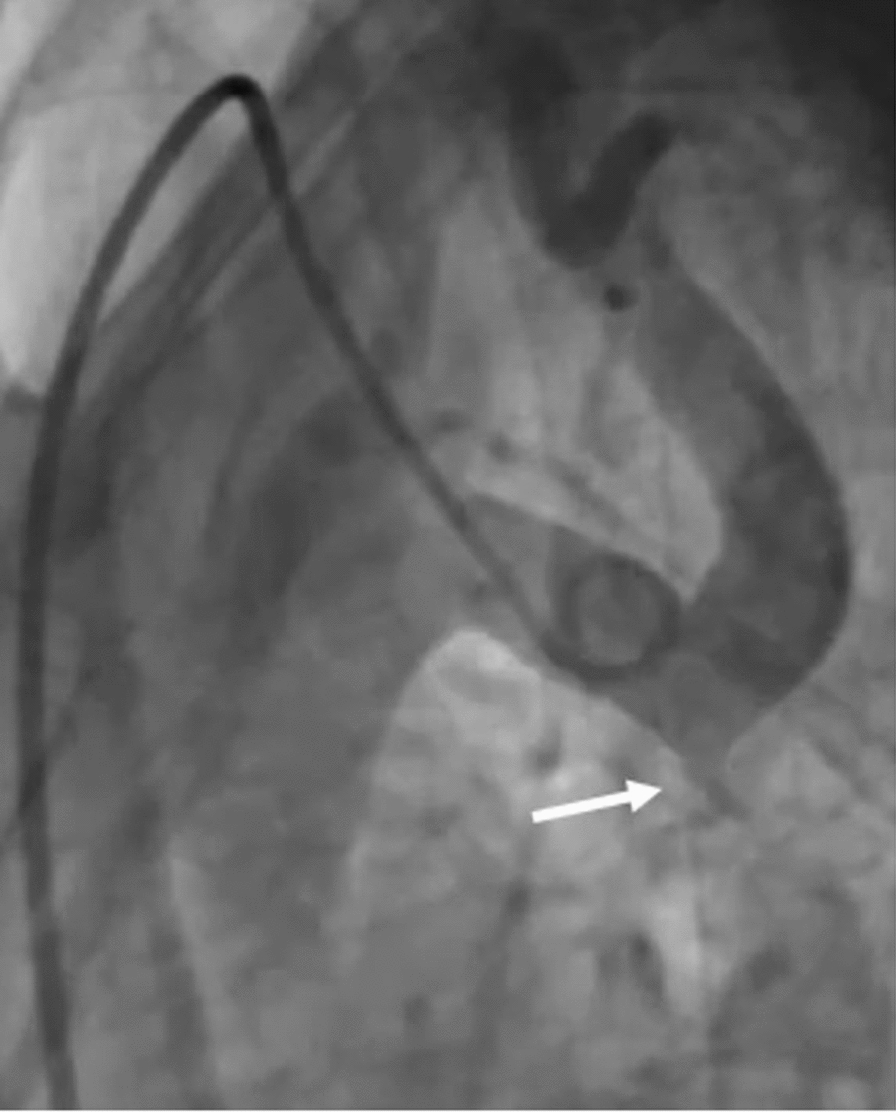 Proximal stent migration during coarctation of aorta stenting