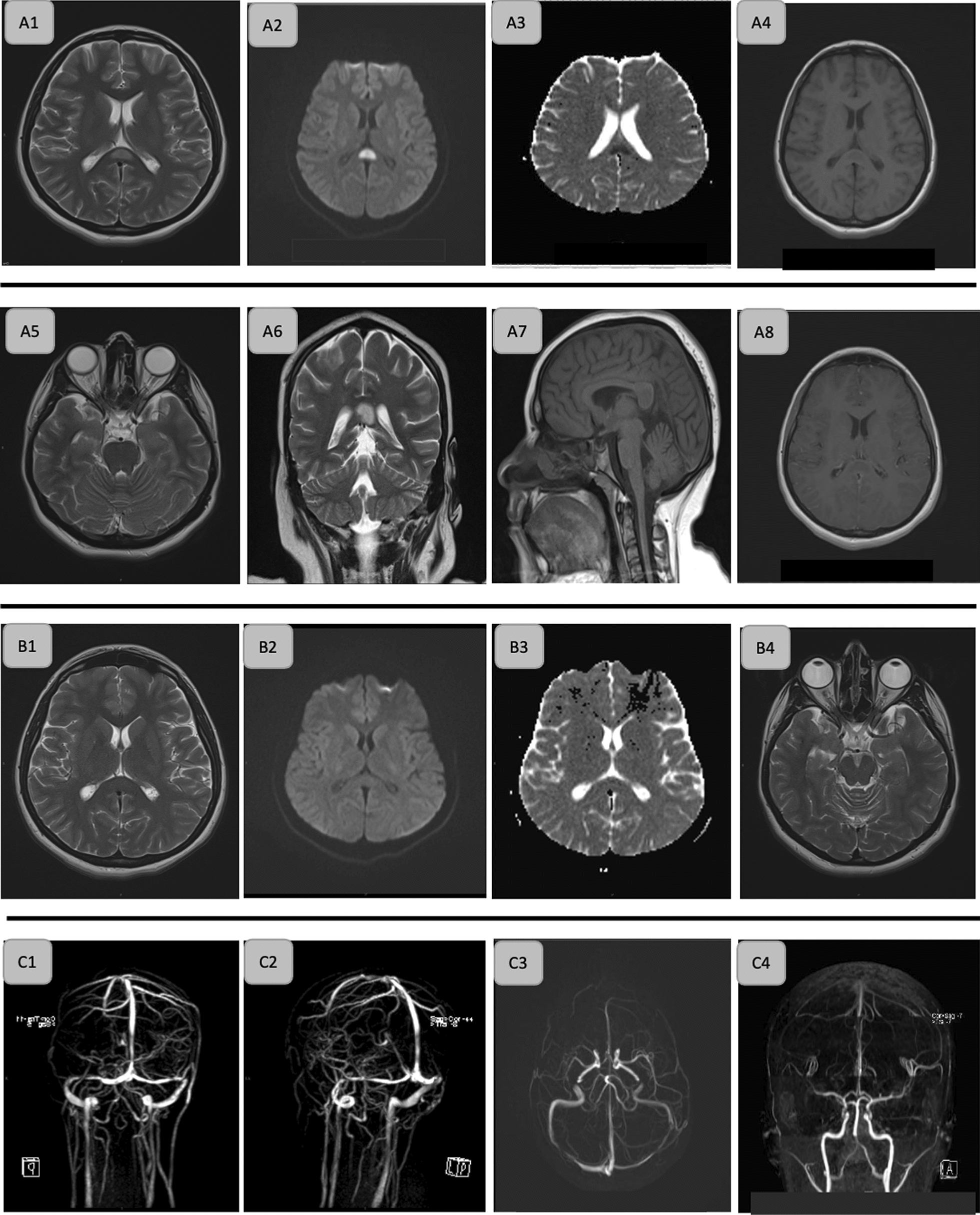 Reversible cytotoxic lesion of the corpus callosum as a radiological finding in idiopathic intracranial hypertension and its association with disease management